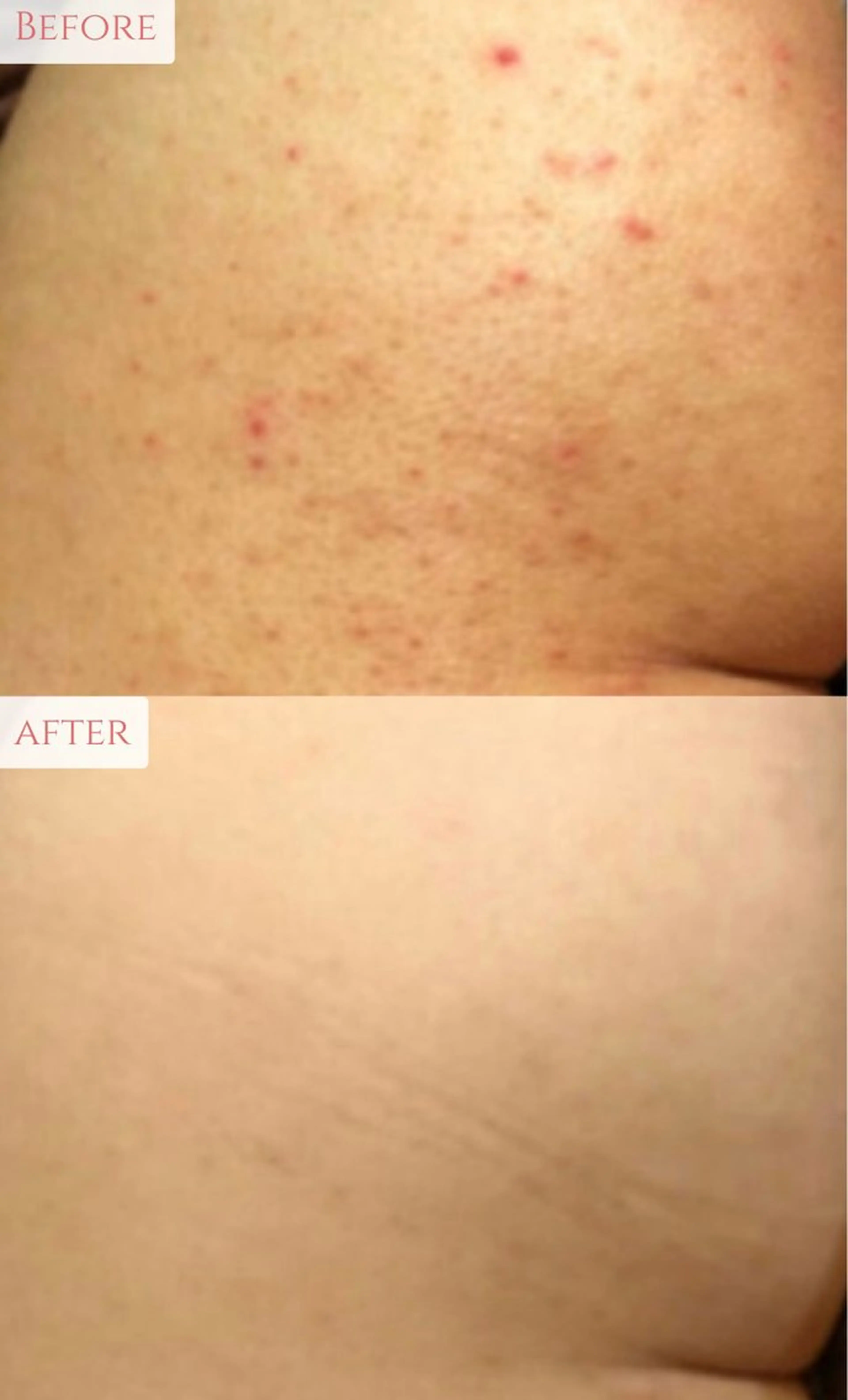 【ミニモ限定価格❤️‍🔥】魅せヒップケア✨剥離ありハーブピーリングで魅惑の美尻へ🍑初回¥22000→¥13000の写真