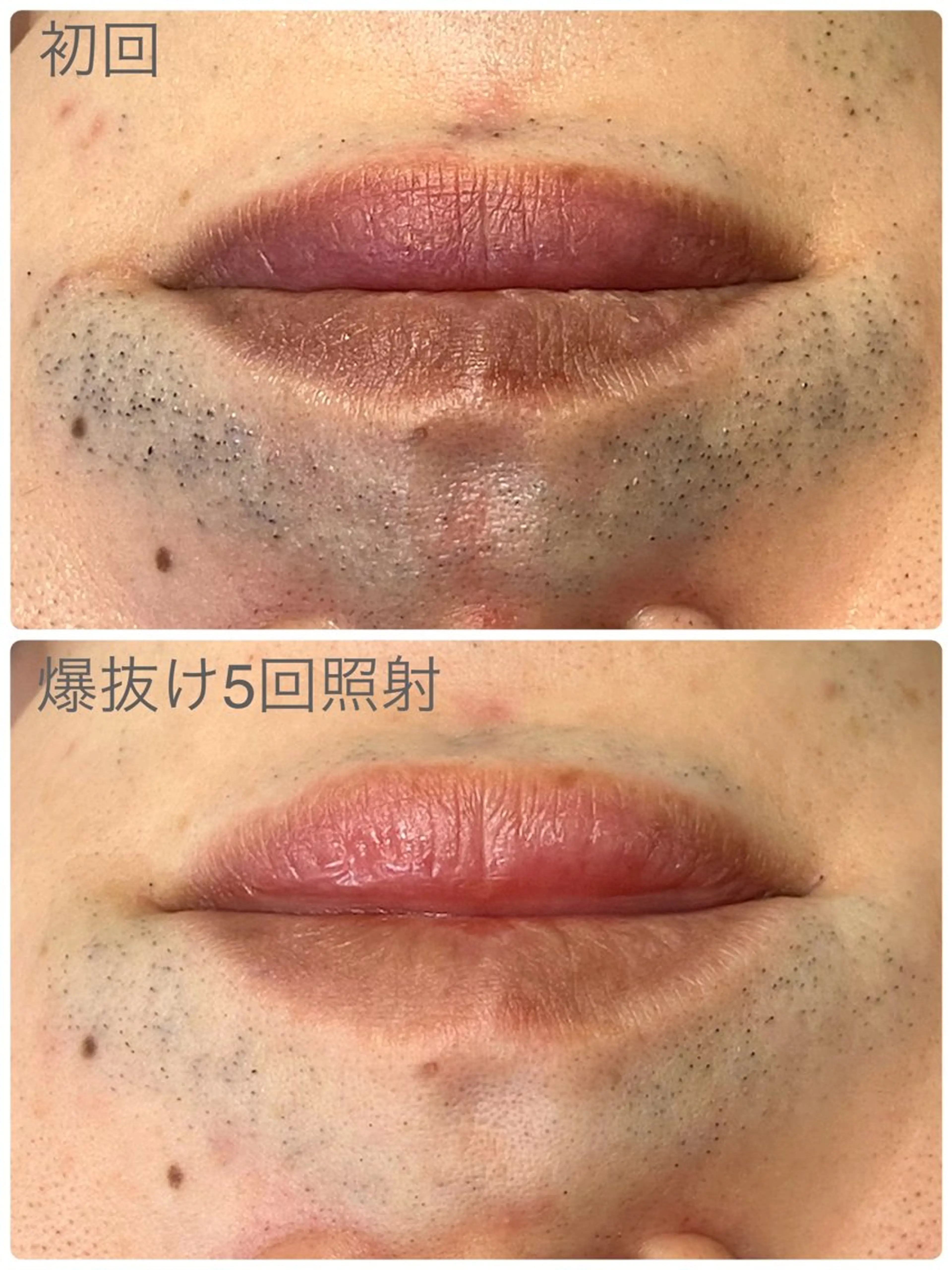 脱毛 Hisui 小出のエステ・リラクイメージ