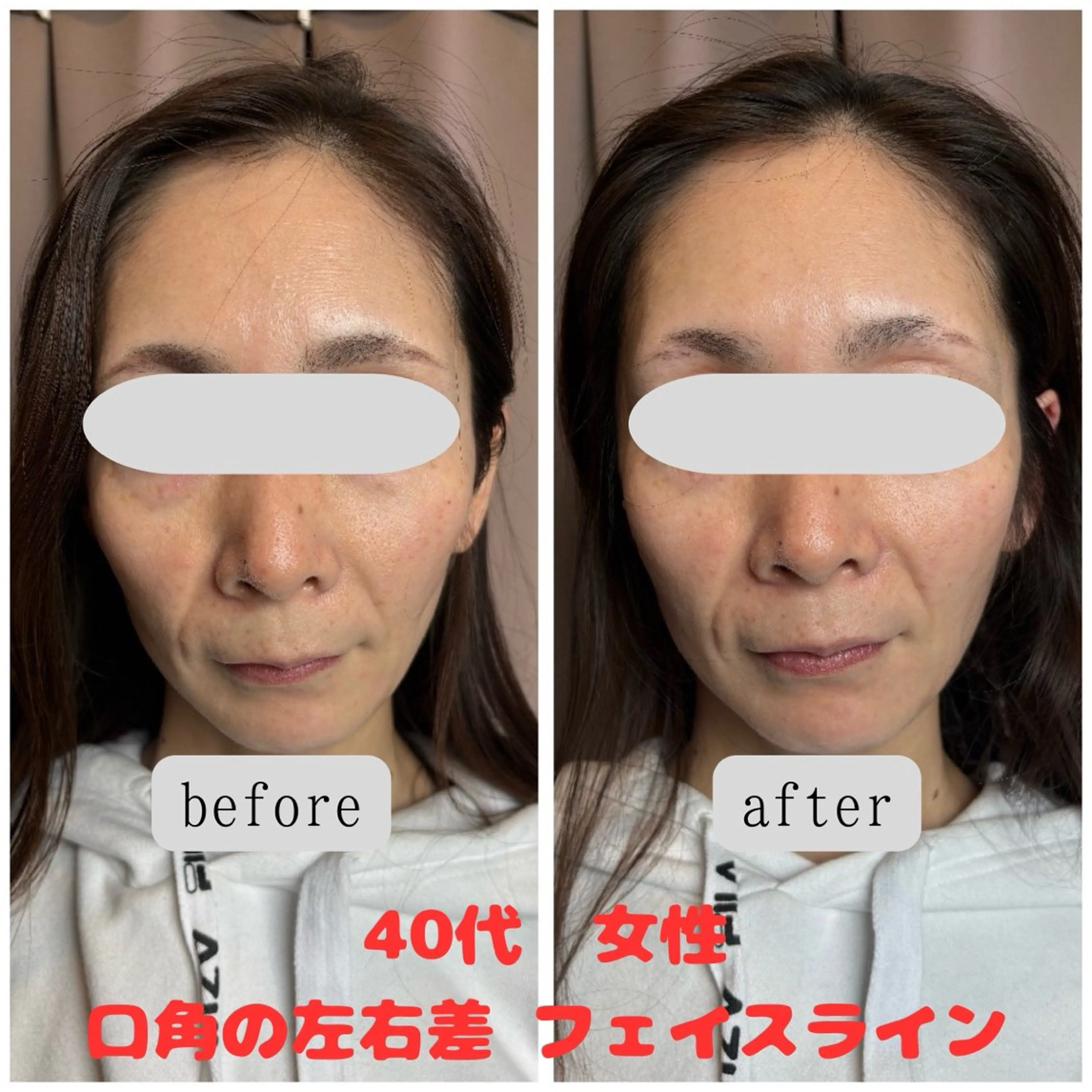 【1月 キャンペーン 残り5名】初回 美顔矯正の写真