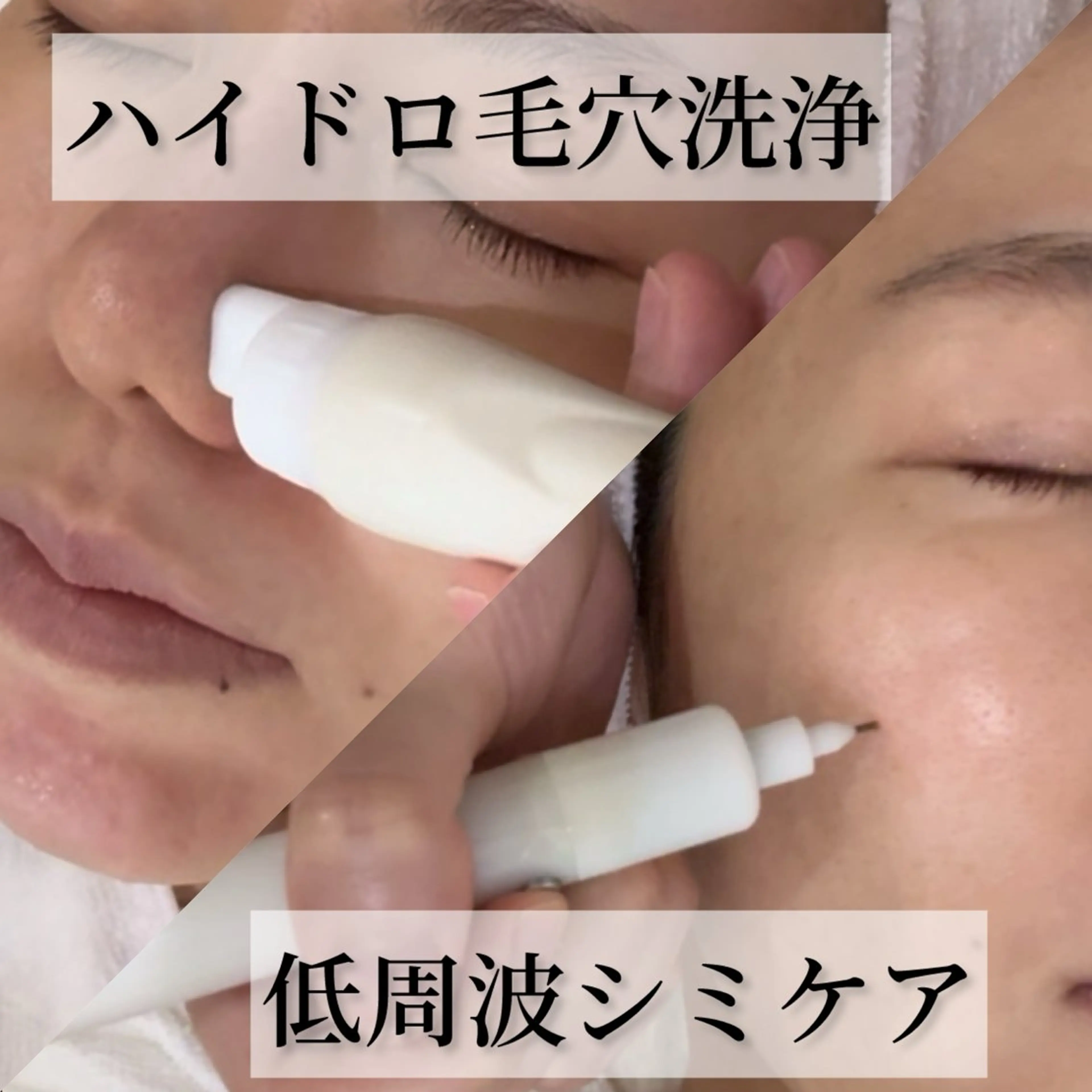 【ハイドロ毛穴洗浄＋シミケア10分】ハイドロ毛穴洗浄Tゾーン＋シミケア10分し放題＋鎮静保湿パックの写真