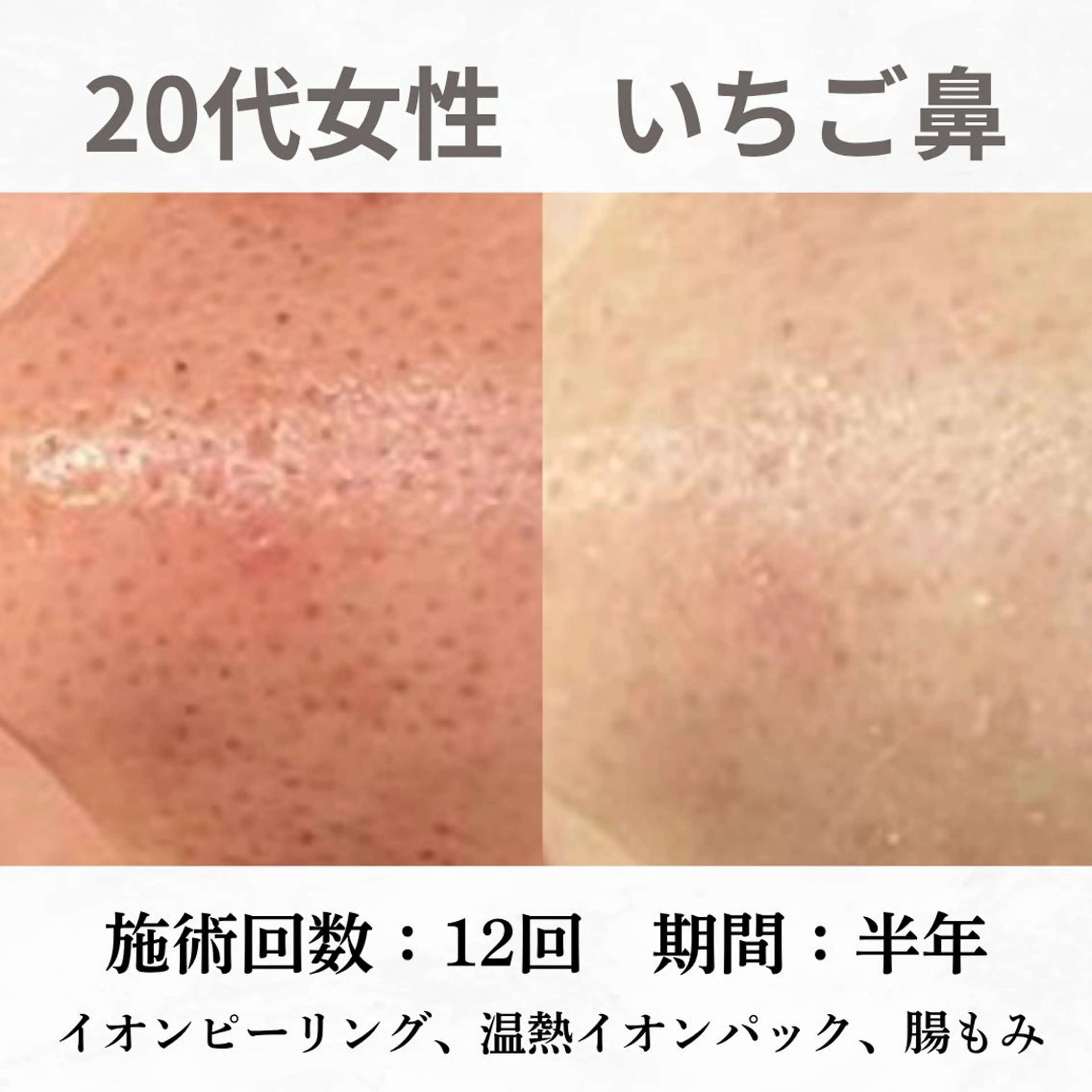 重度ニキビ専門🌷 ダウンタイムなしのエステ・リラクイメージ