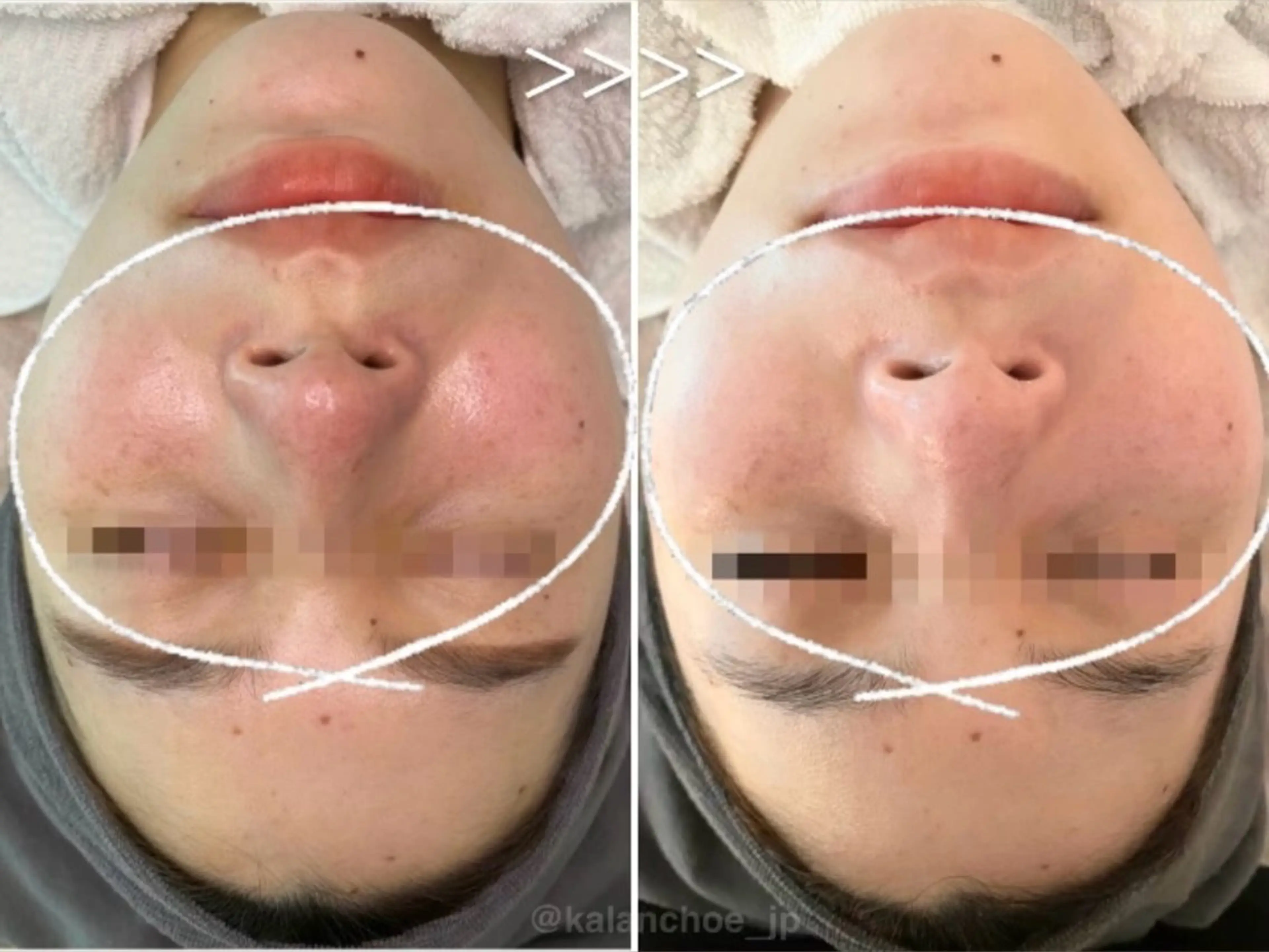 エステ 肌質改善 KALANCHOEのエステ・リラクイメージ