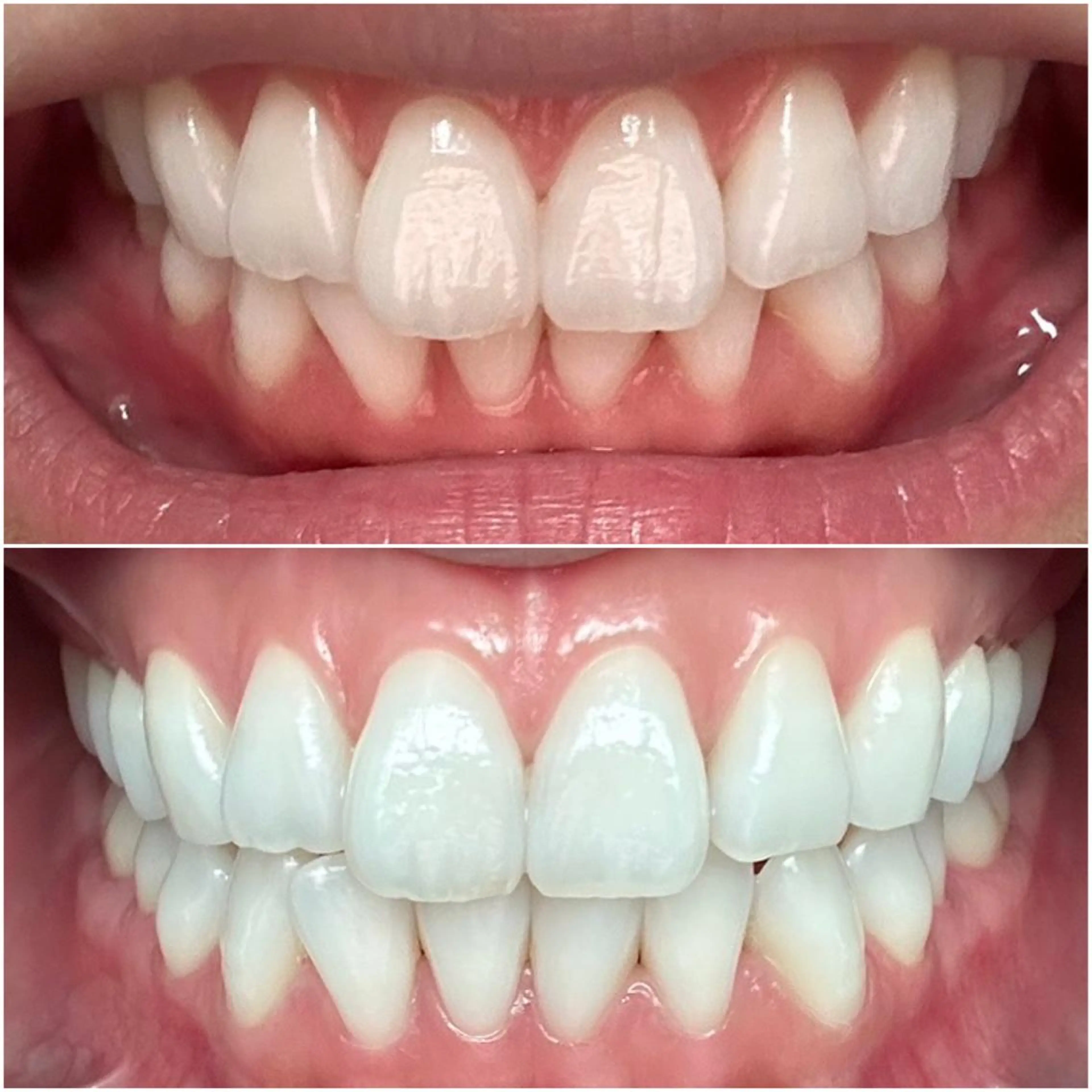 【歯の黄ばみに】ホワイトニング20分照射☆本当に白くなる♪と好評😄 まずはお試し✨の写真