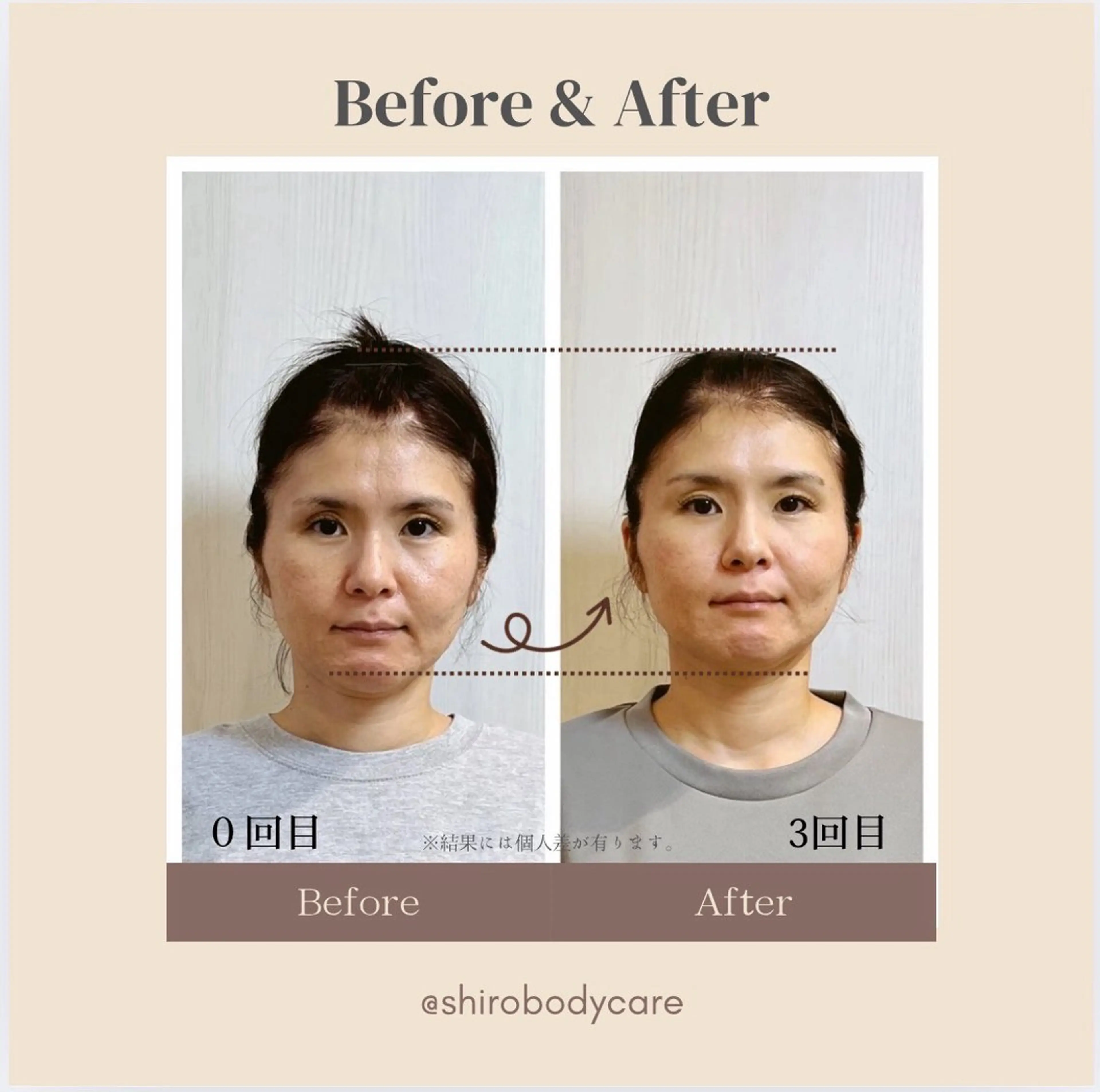 小顔矯正勝山式 shiroしろのエステ・リラクイメージ