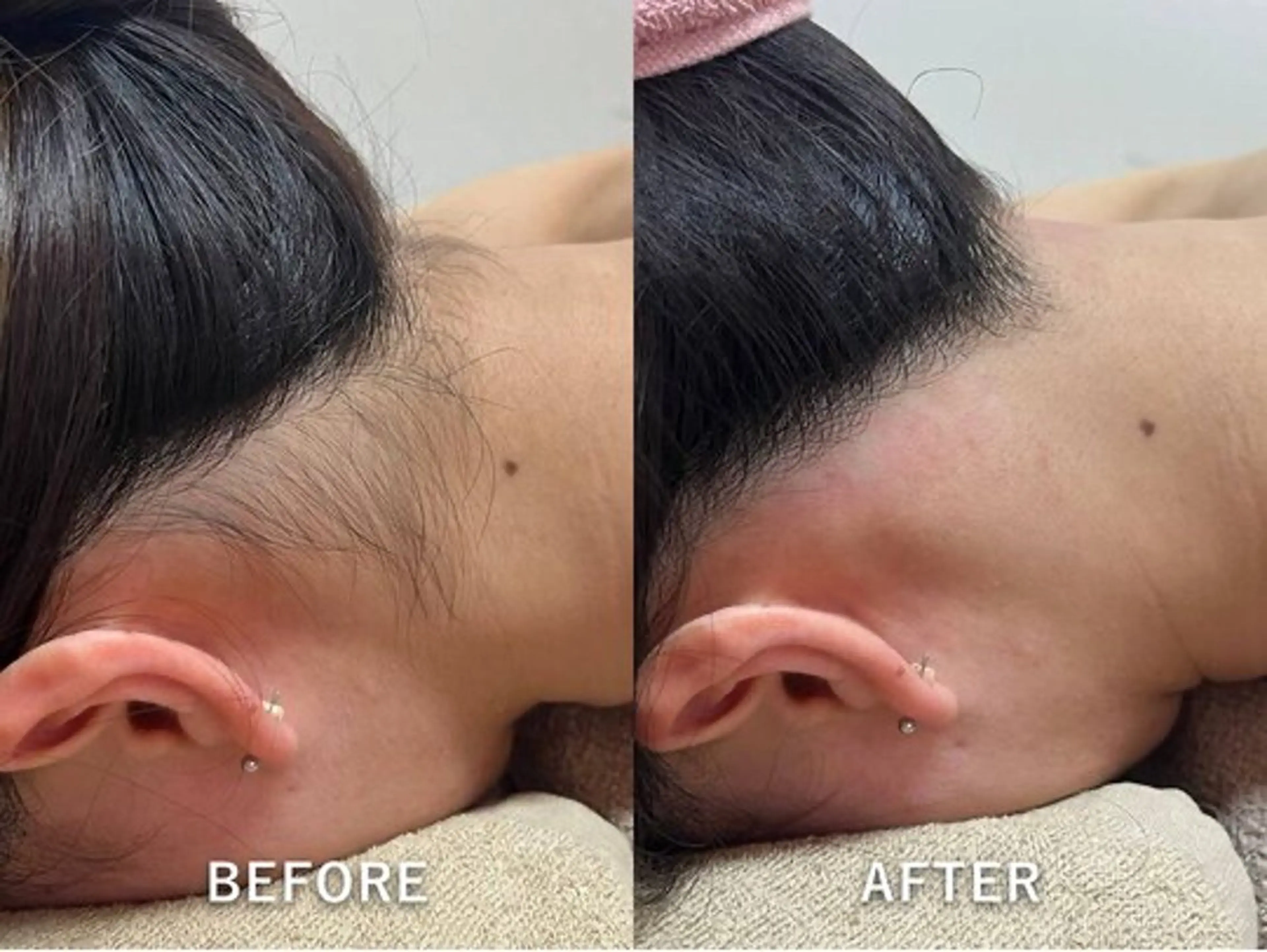 後ろ姿も可愛くデザイン💘韓国風仕上げシェービング付 うなじ脱毛の写真