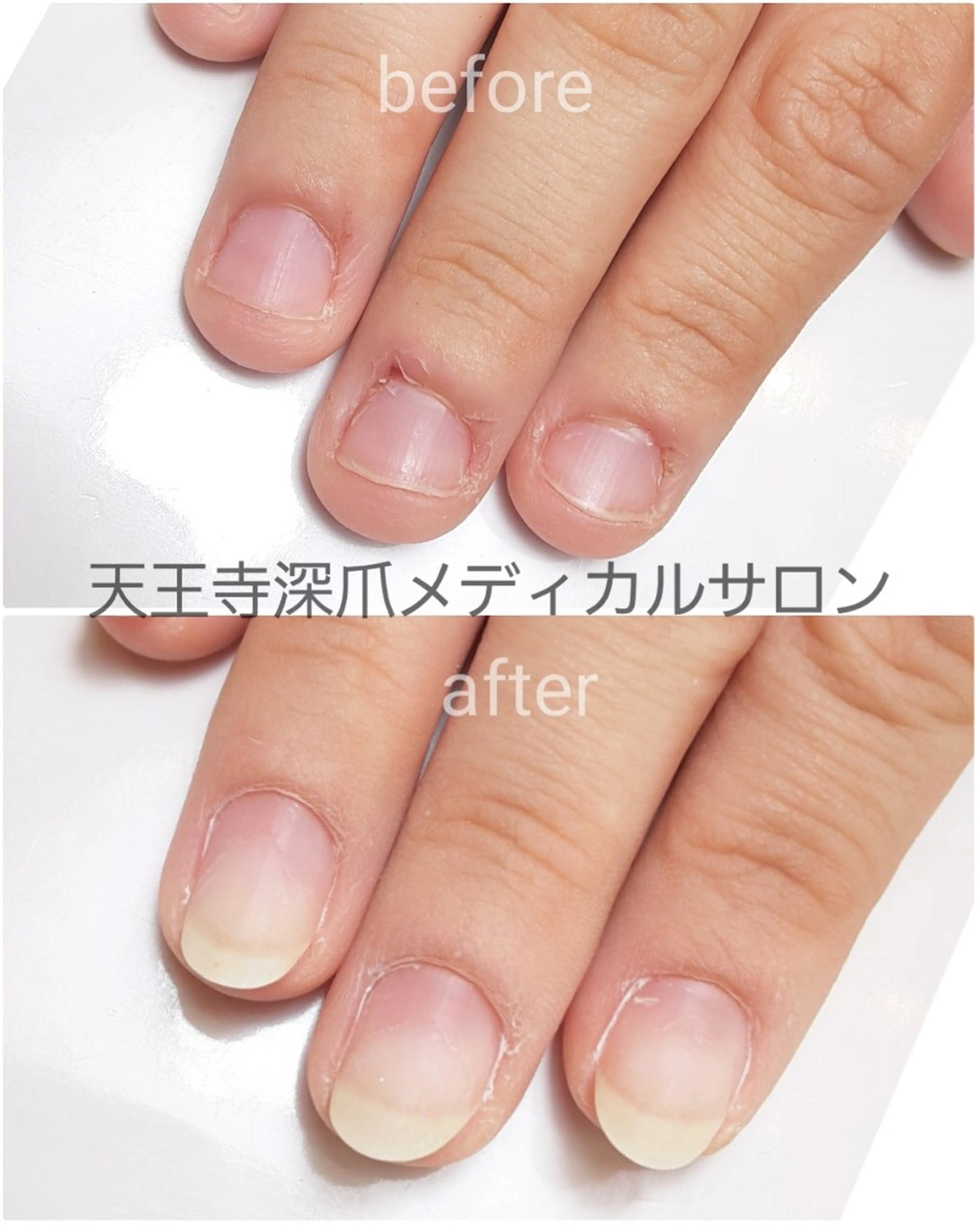 ネイル 天王寺 深爪メディカルサロンのネイルデザイン