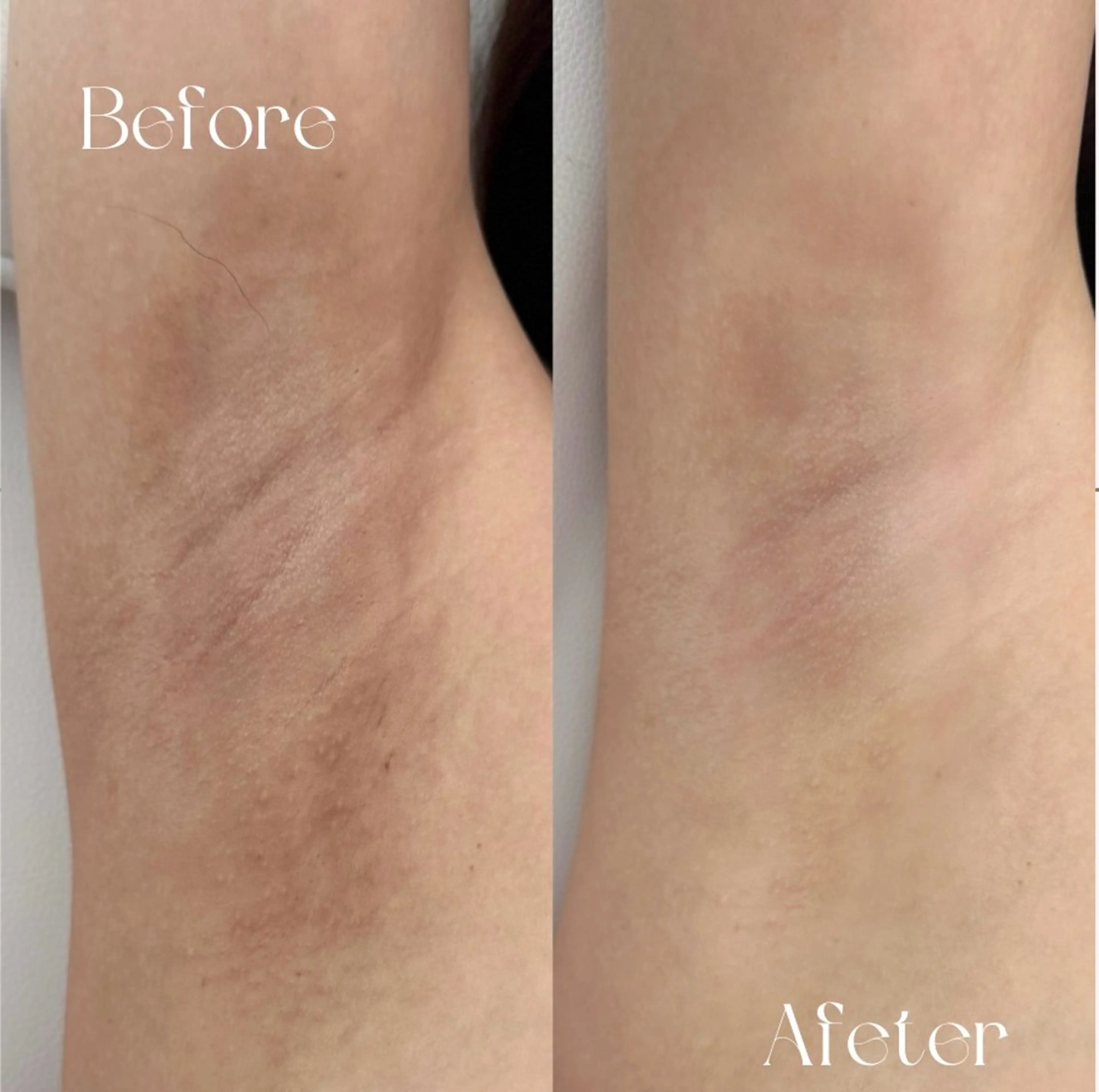 60%OFF(特典含む)【ローマピンク🩷デリケートゾーン】アフタークリーム3本(39,600円)＋ヒアル導入プレゼントの写真