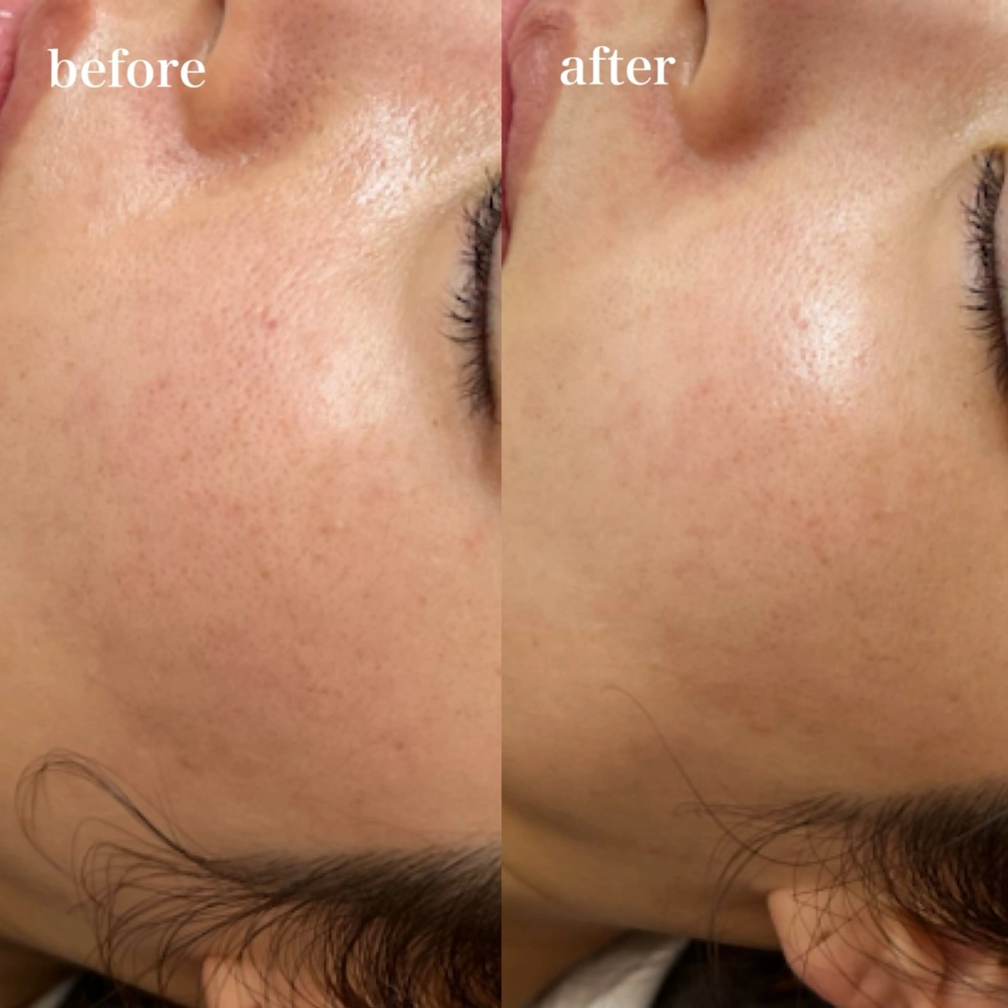 韓国美容✨【第四世代ピーリング🇰🇷全顔+首】の写真