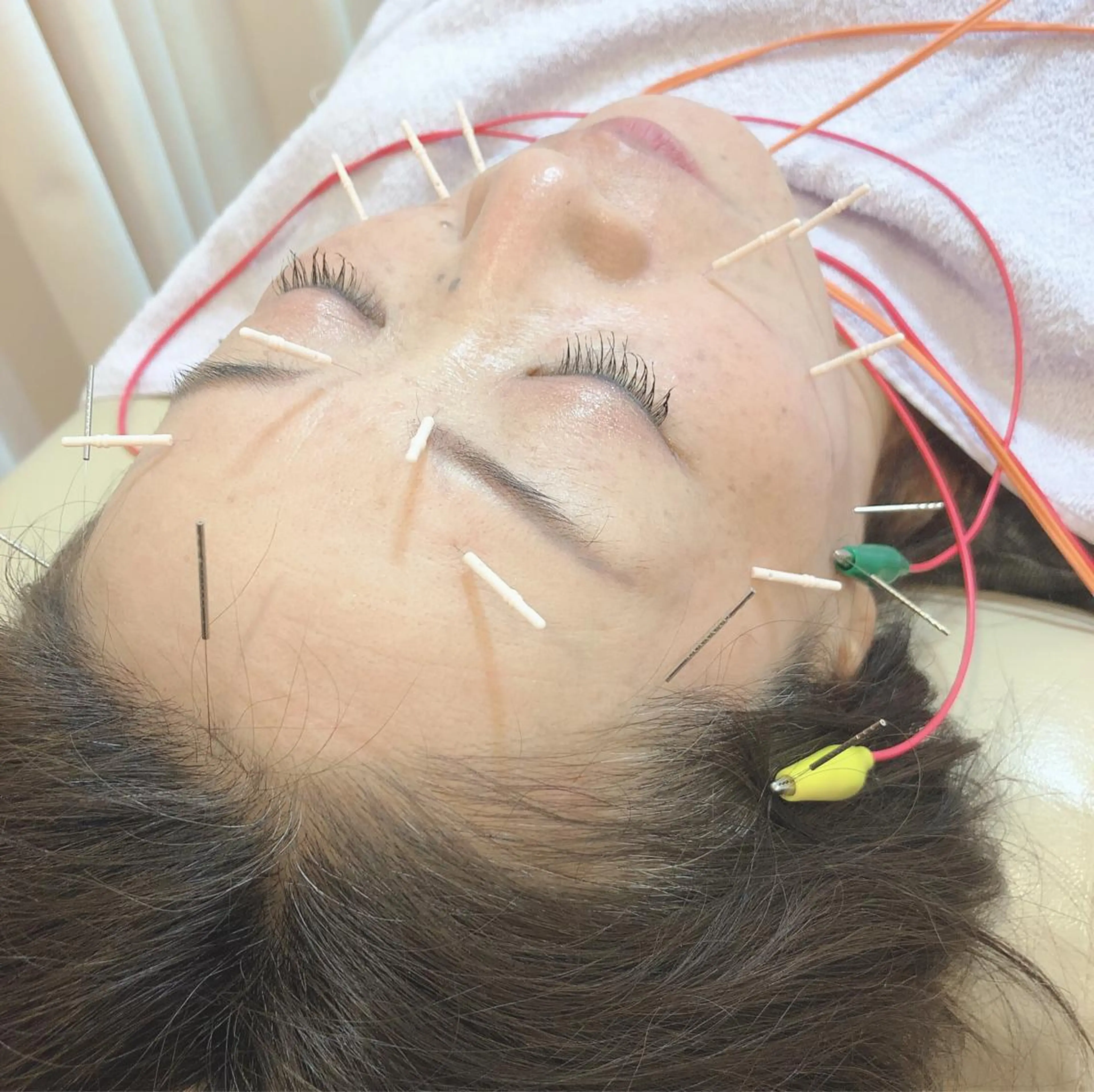 リフトアップ・たるみ ☆美容鍼小顔矯正のその他イメージ