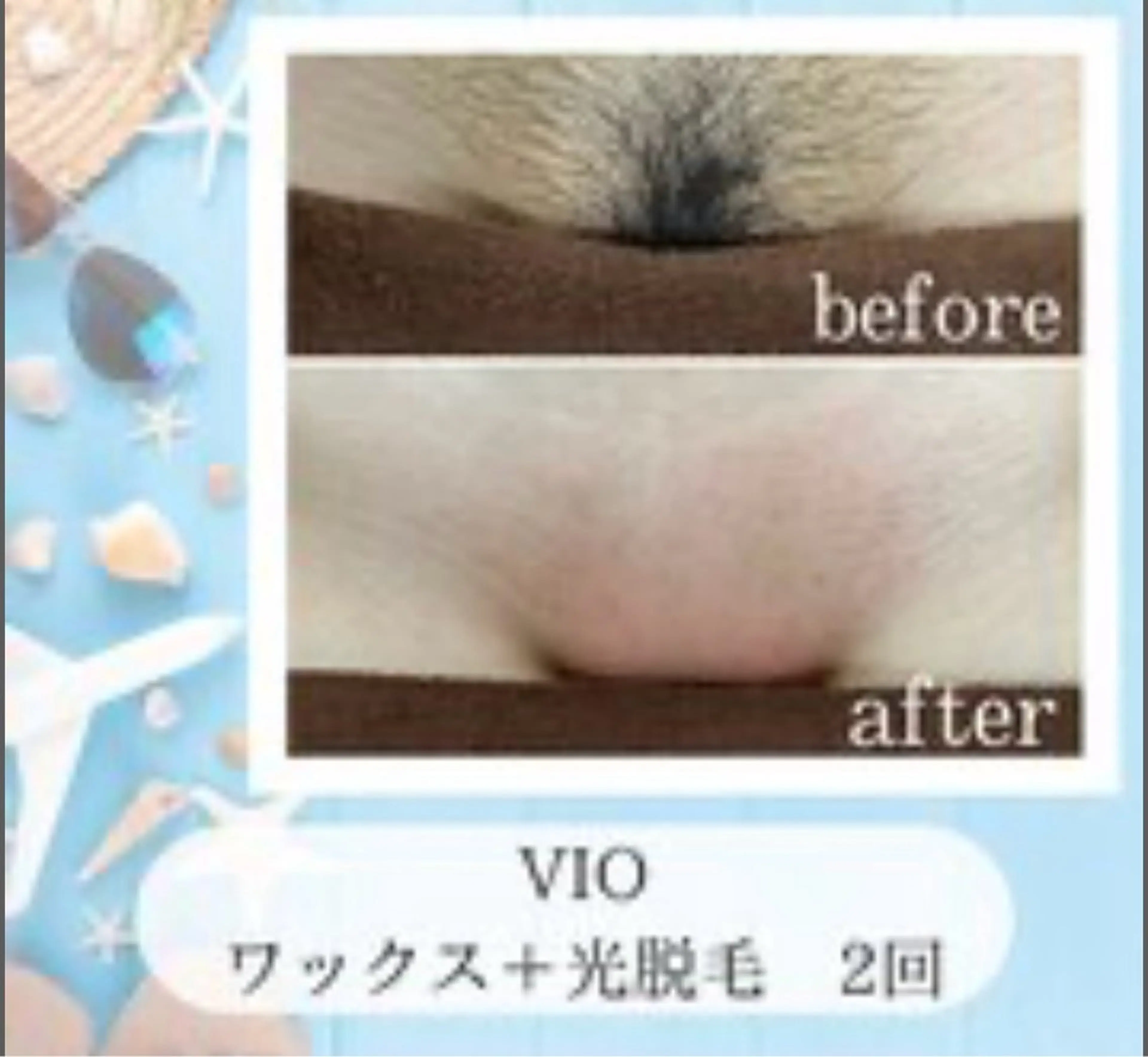全員脱毛【女性/8/31迄/夏目前!始めるなら今!】VIOワックス+光脱毛2回券¥19,800の写真