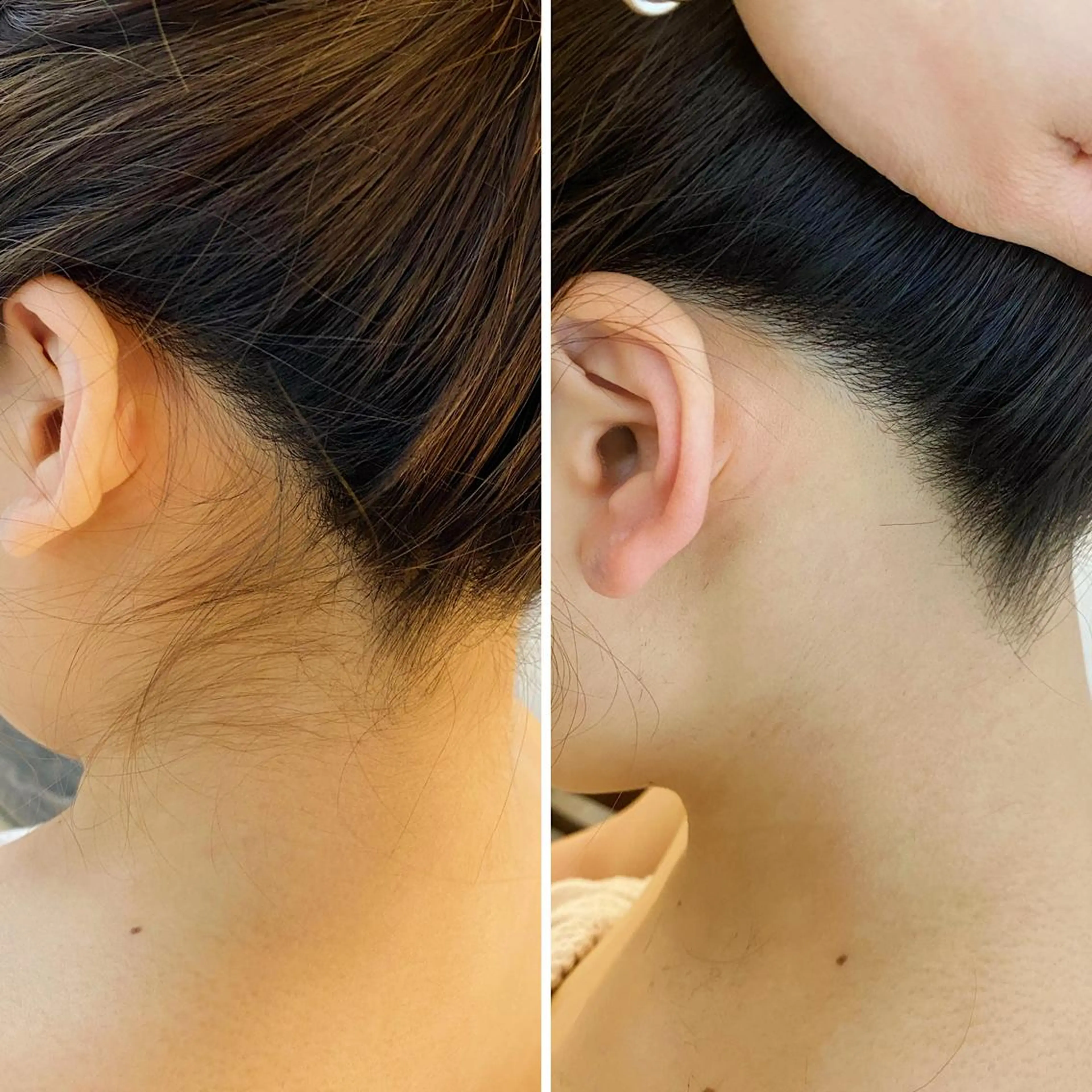 脱毛 うなじ脱毛/美肌脱毛 LABELのエステ・リラクイメージ