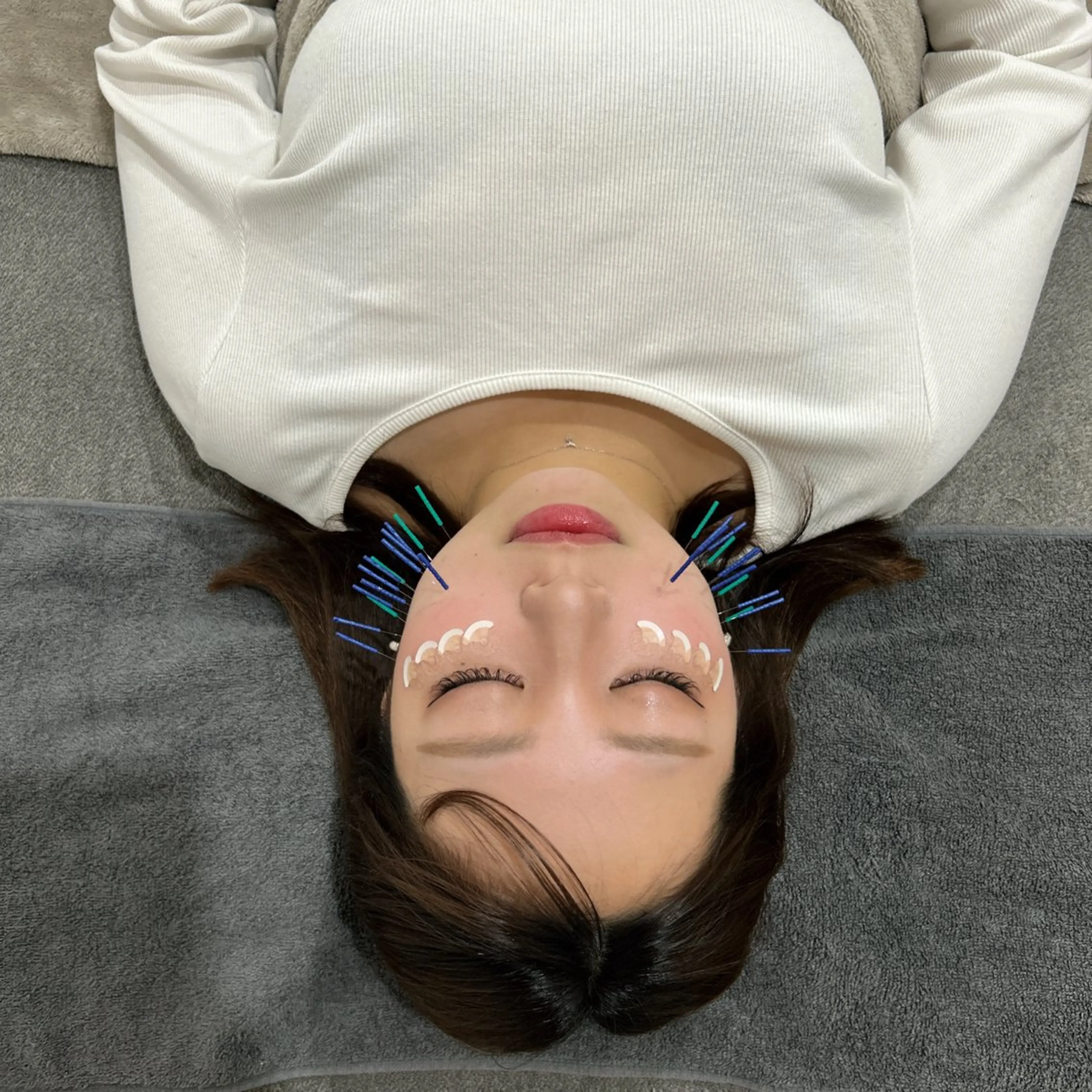 《ミニモ学割U24》美容鍼の写真