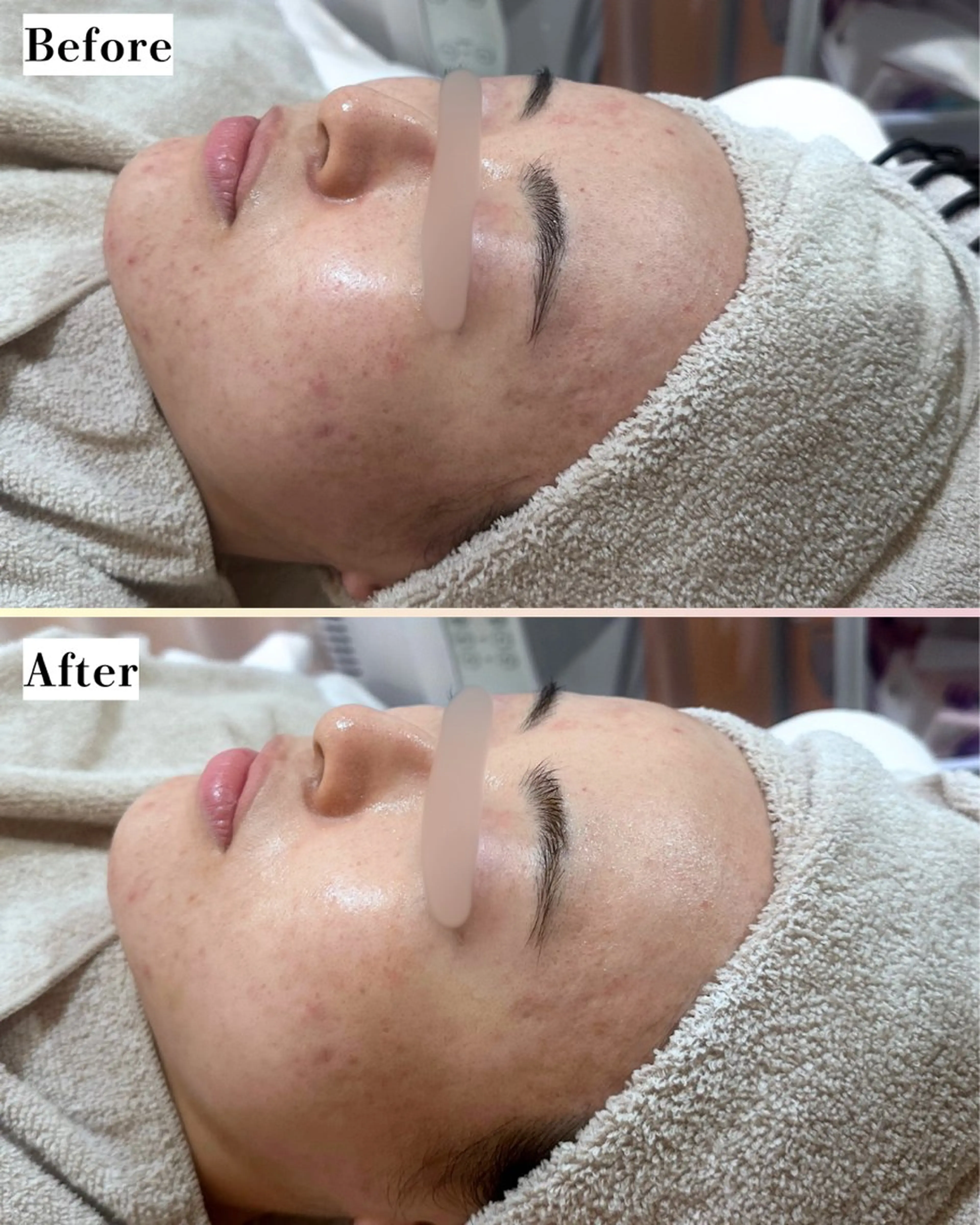 |ピーリング・毛穴| soina神楽坂のエステ・リラクイメージ