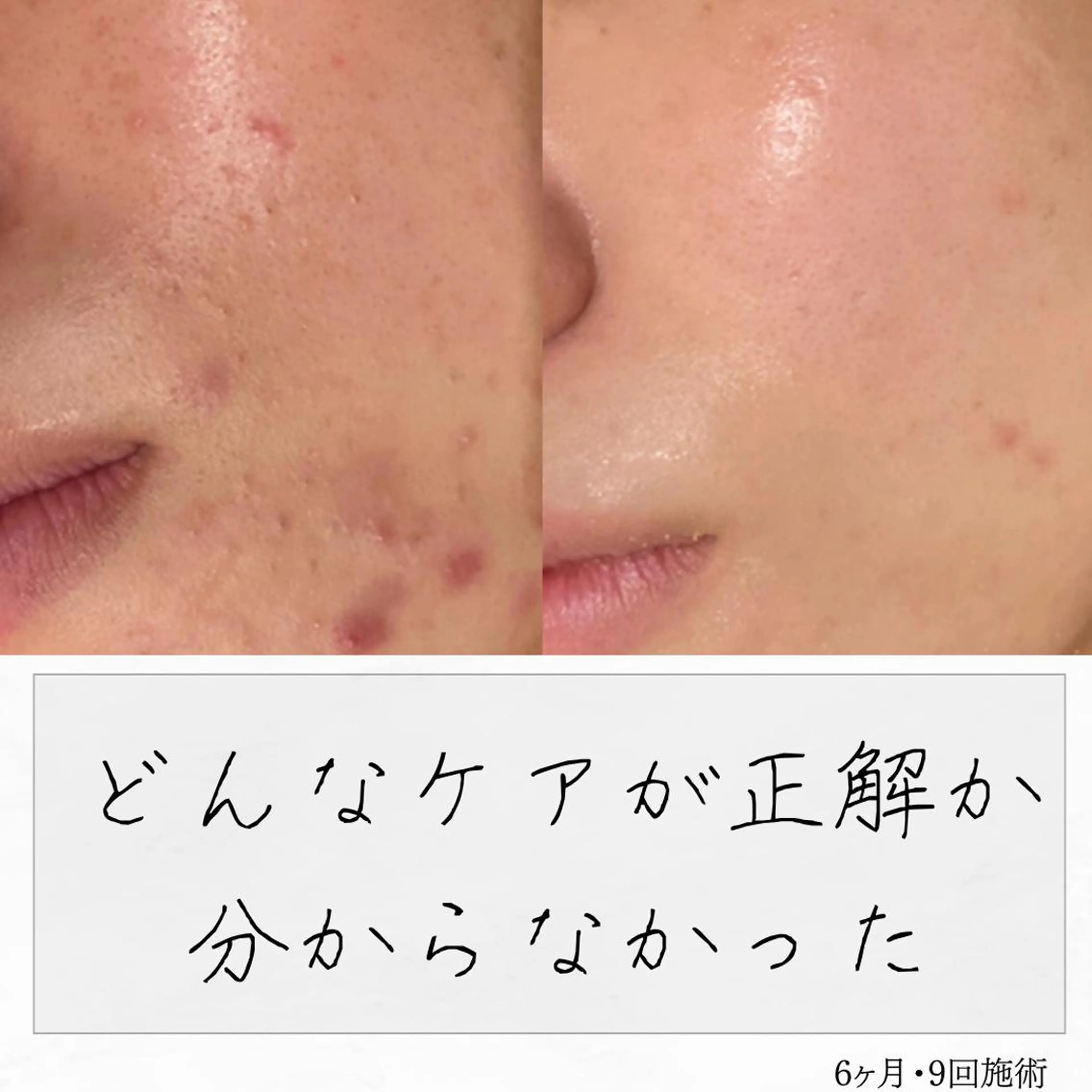 ニキビ経験者が施術 する専門サロン🌻のエステ・リラクイメージ