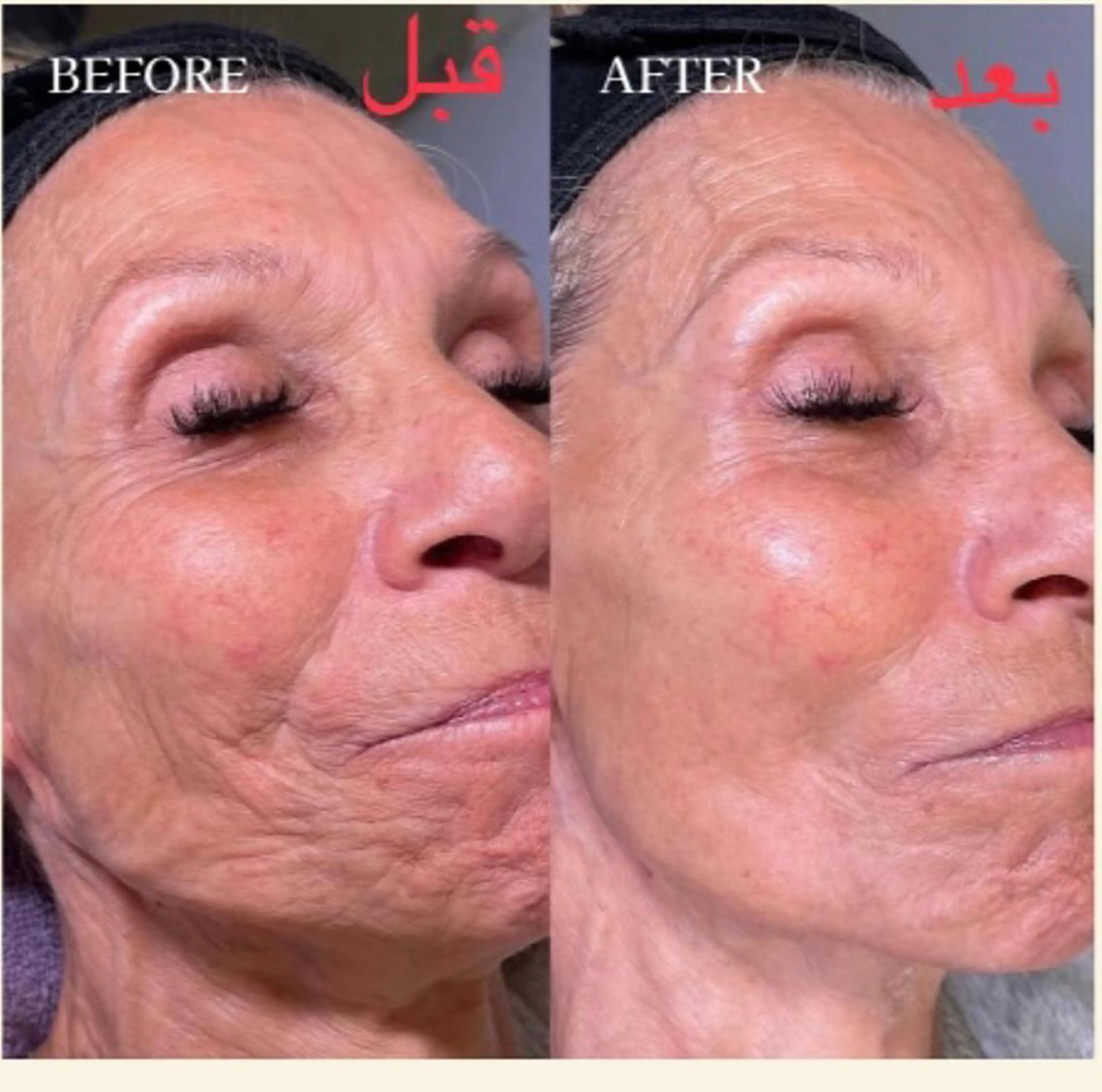 【シワ、たるみ、毛穴ケア】カーボキシー＋ゾンビマスクの写真