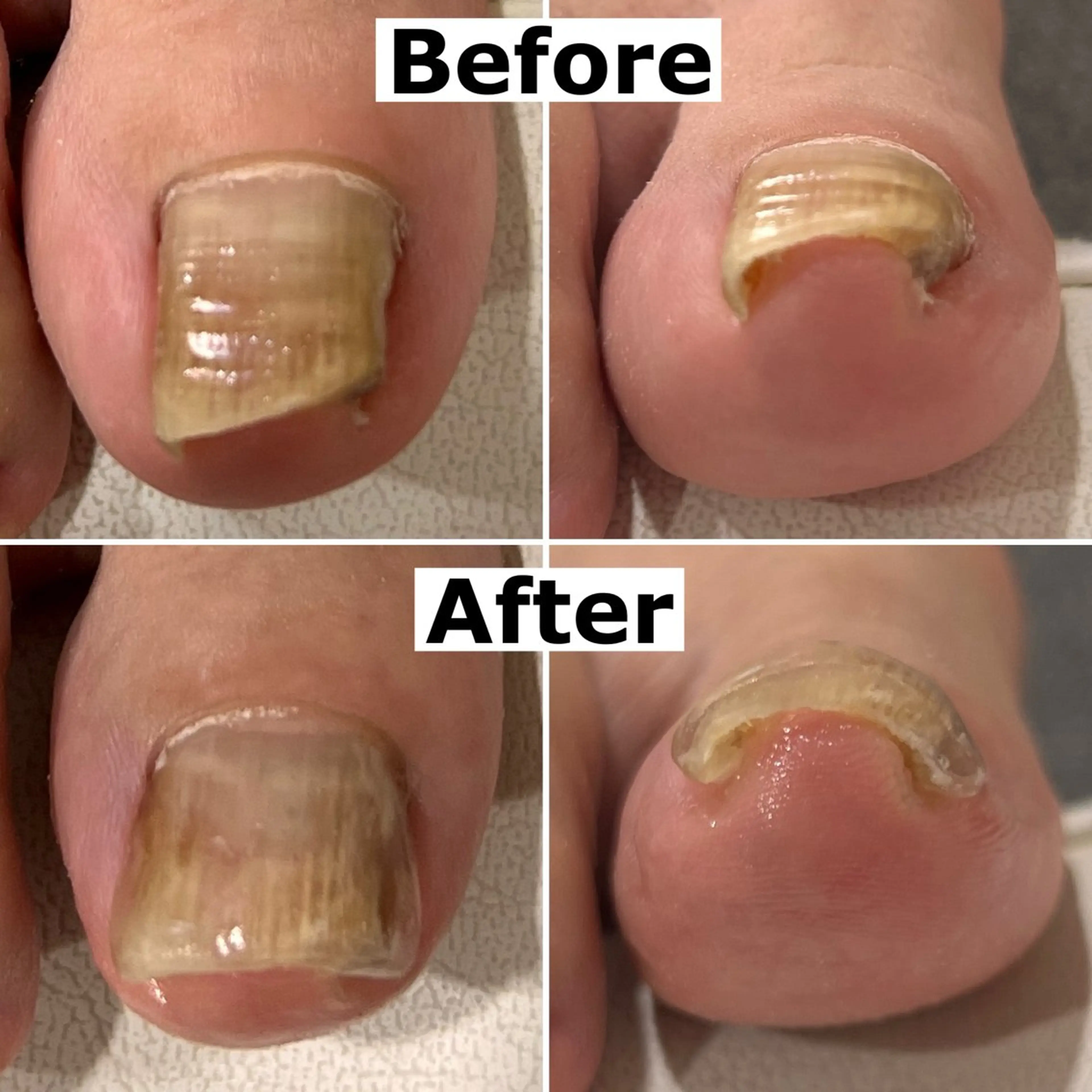 ネイル Mellow nail所属・巻爪無料モデル募集 ✨🦶MEGUMIのネイルデザイン