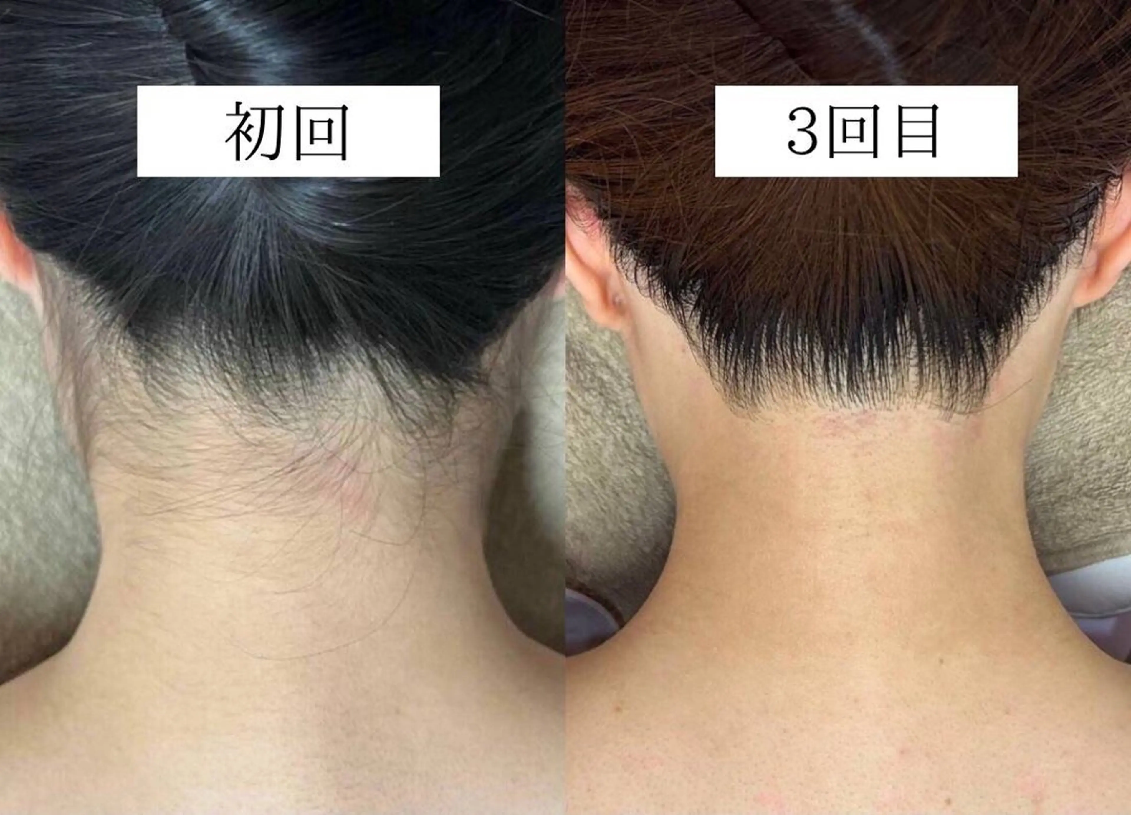 【成人式前撮り・イベント前に】うなじ＋お顔脱毛シェービング・高保湿パック付き🪒の写真