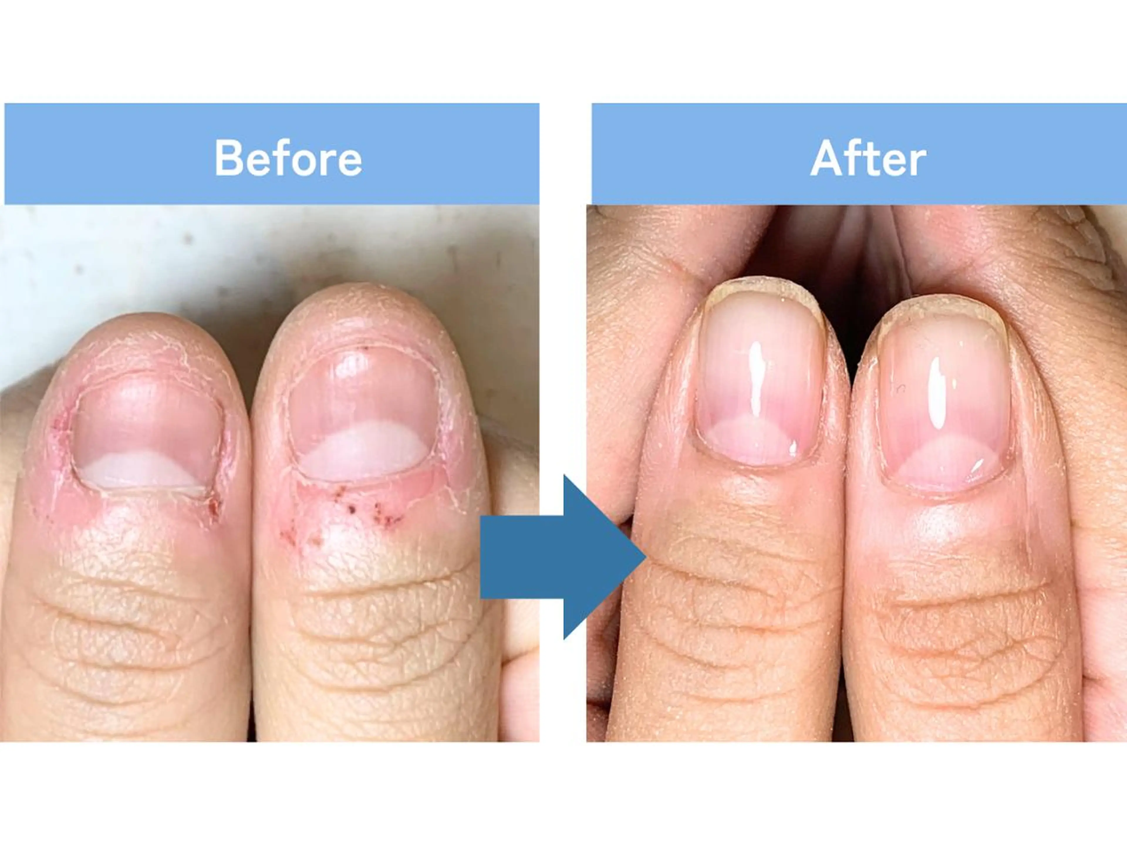 ネイル 深爪矯正・自爪育成 ネイルサロンアモまいのネイルデザイン