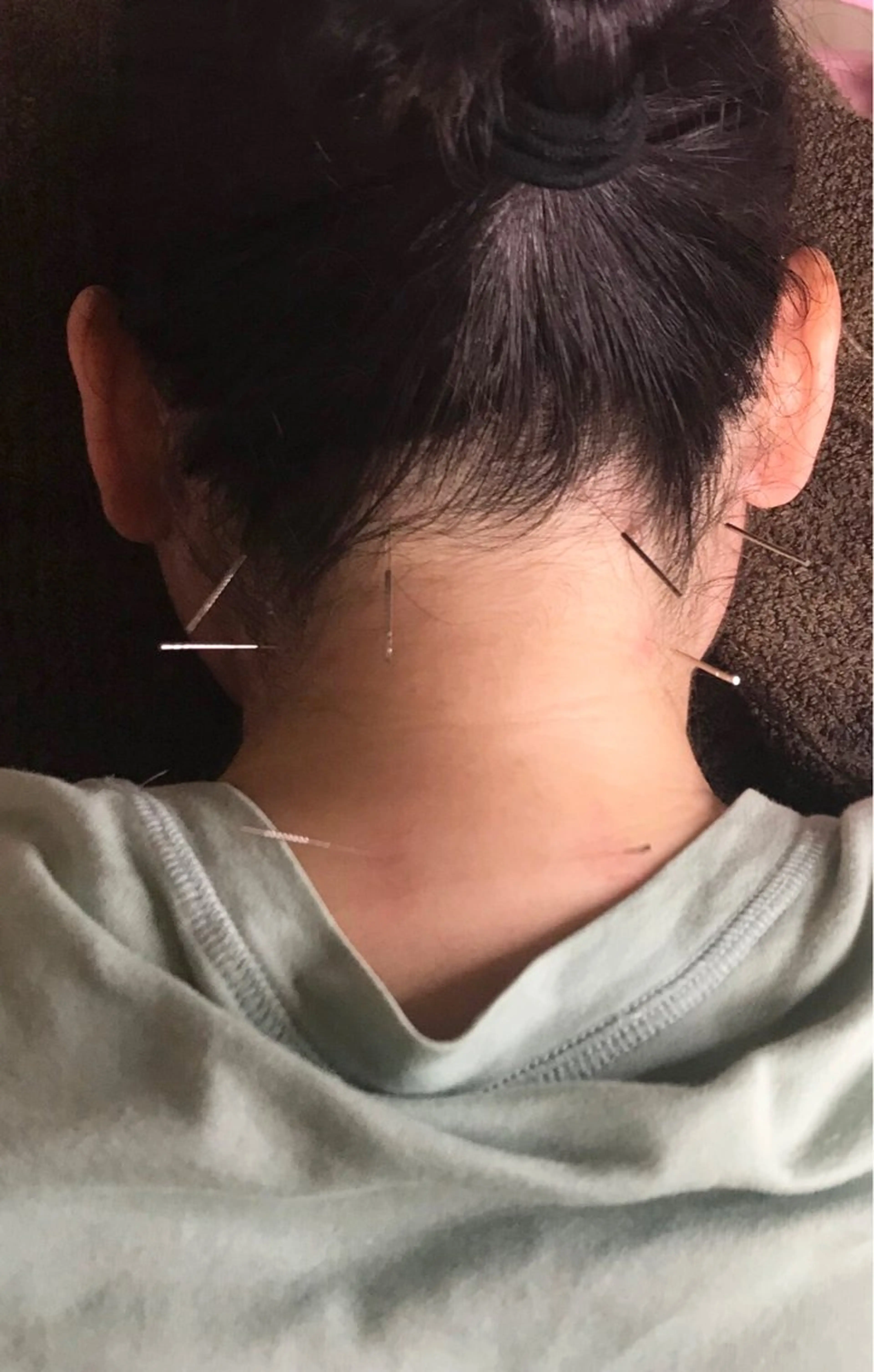 🌈ミニモ限定メニュー🌈【首・肩】部分鍼灸コース🕰️30分4,950円↓❣️首・肩に対して集中的に施術🔥の写真