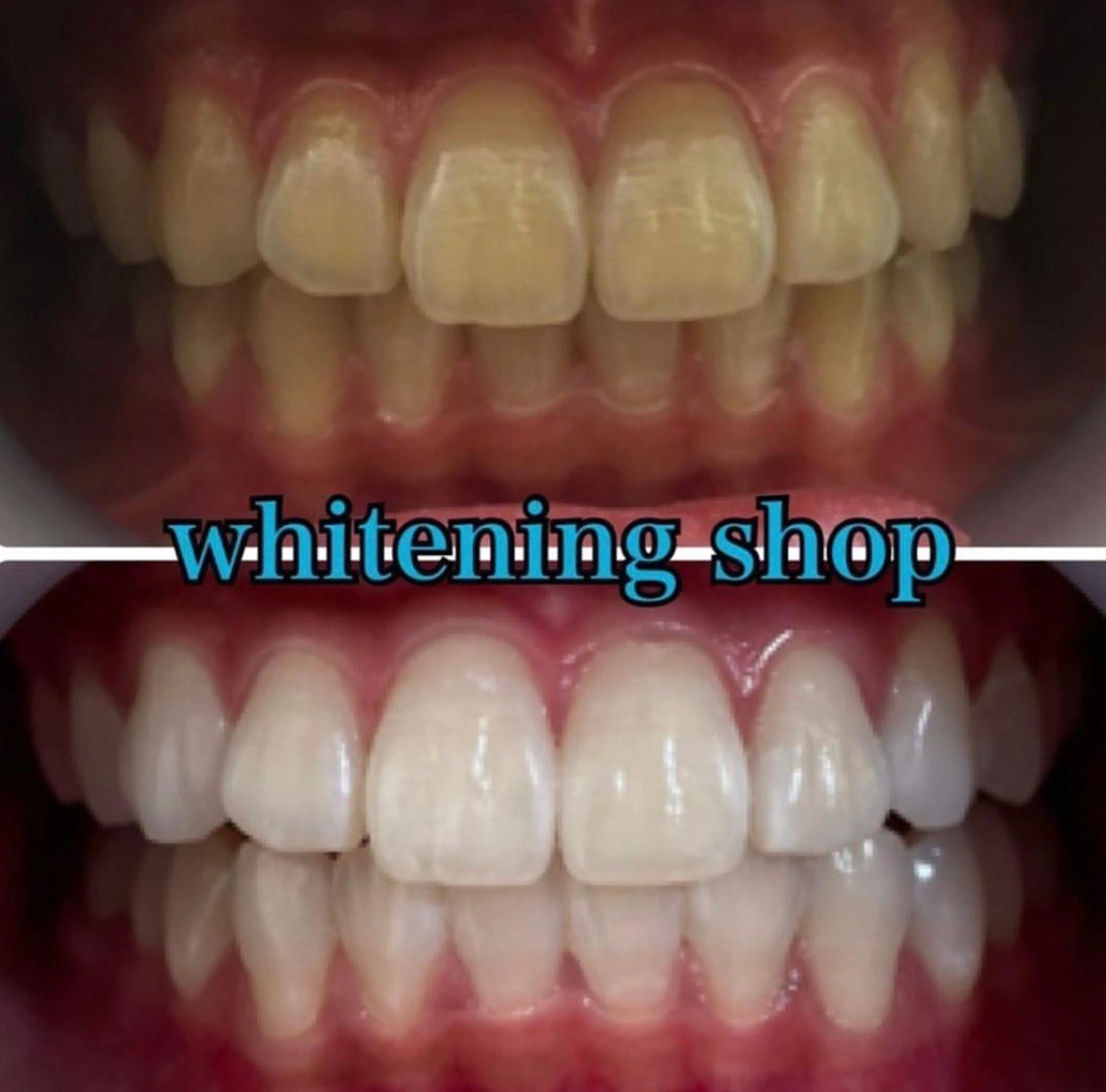 【💓2回目以降回数券お持ちでない方💓】ホワイトニング20分×2回照射¥8,800の写真