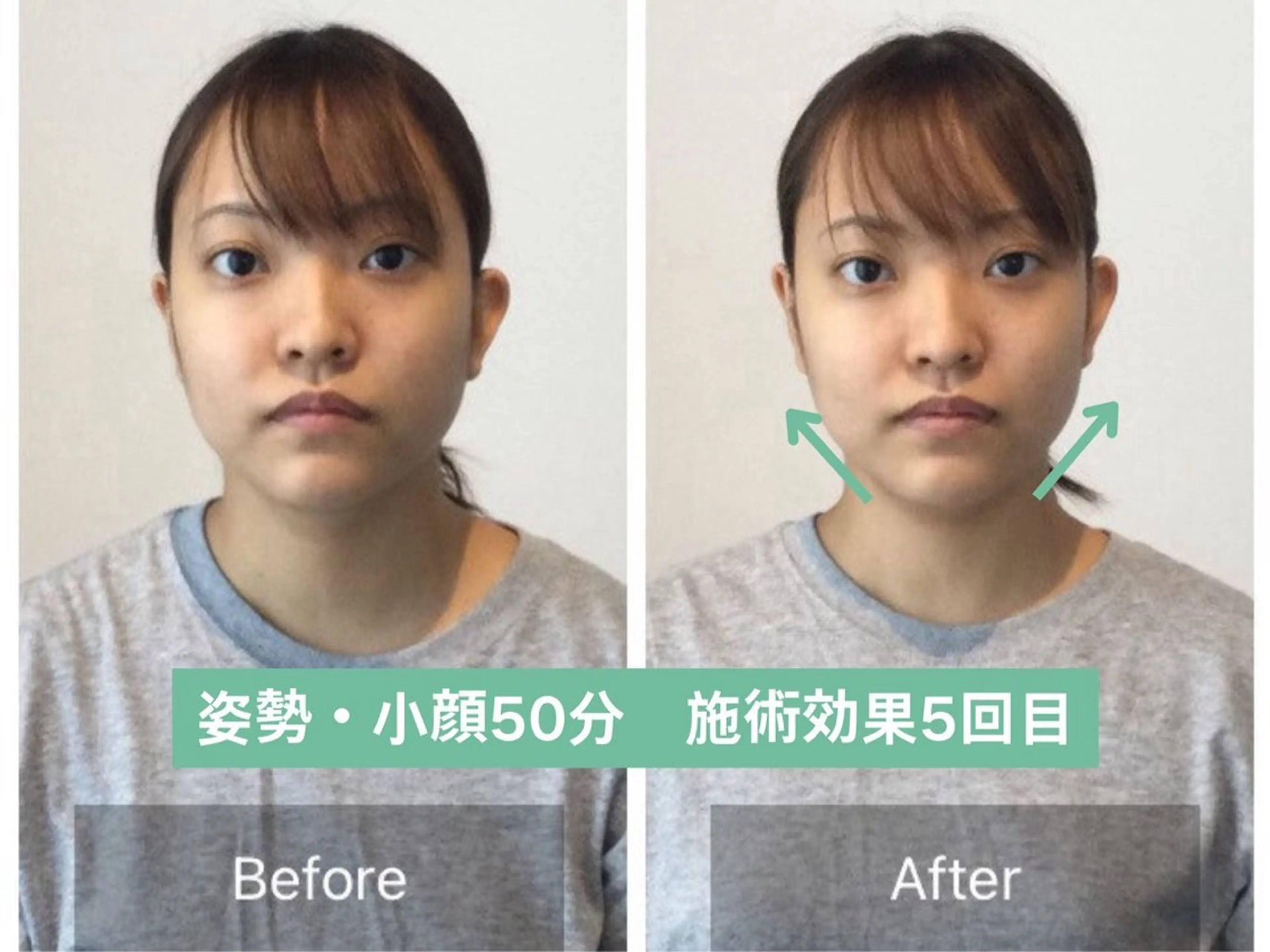 【3.40代必見！】法令線の深さ／骨格リフトアップ小顔矯正【50分17900→3900】の写真