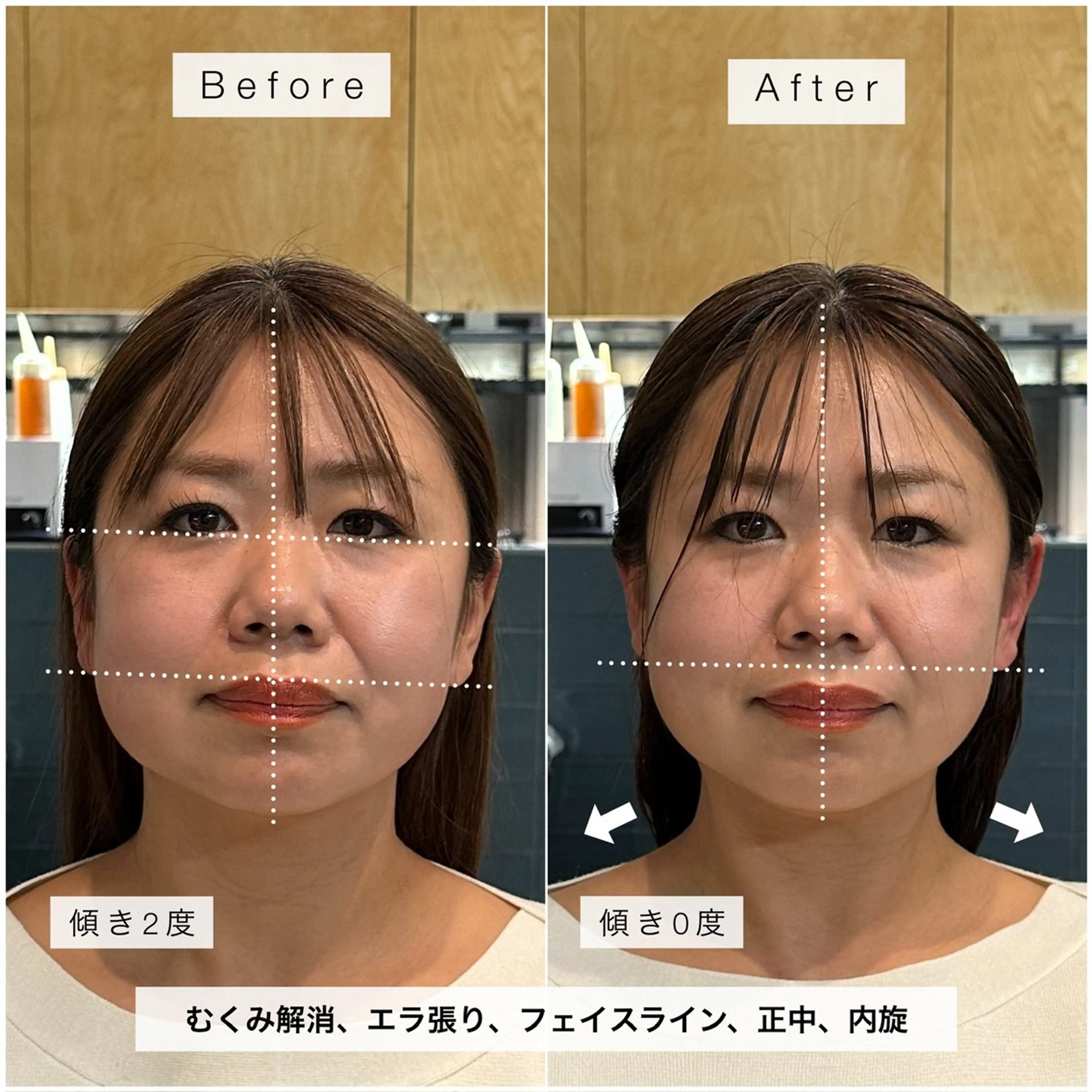 【整形なしで小顔‼️】お顔の歪みを整える「骨格補正スパ」🍀.*の写真