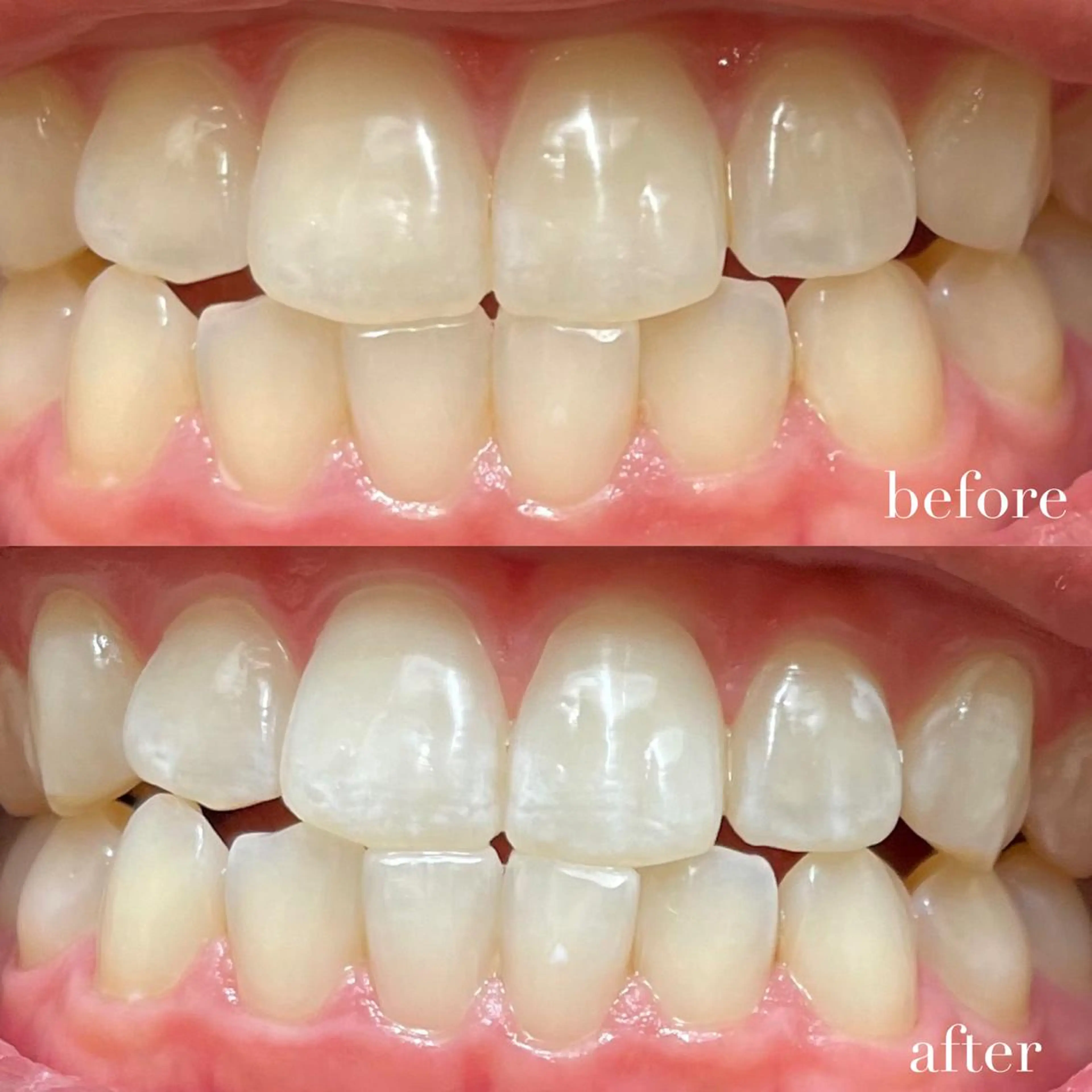 10分照射×2セット❣️minimo限定5分照射プレゼント💐‎🤍の写真