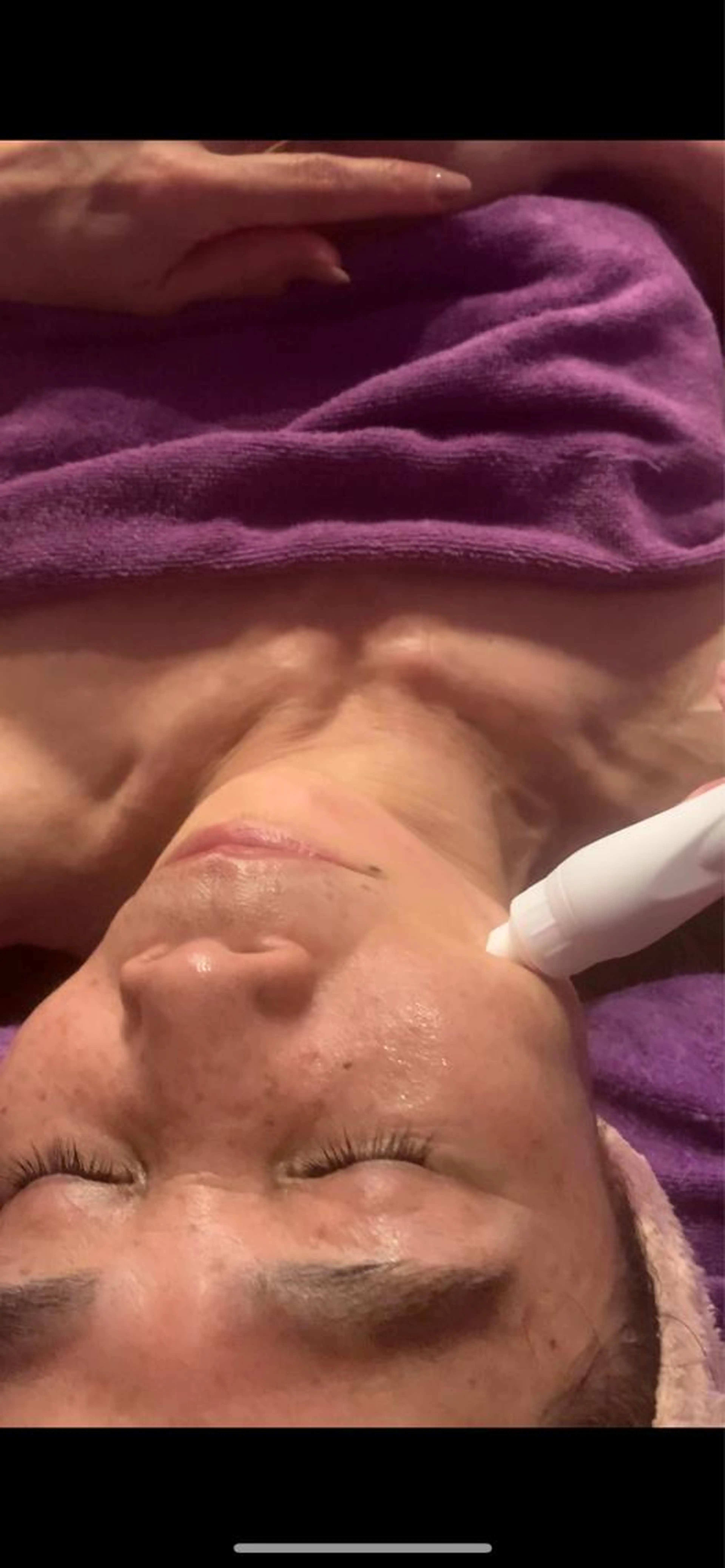 ハイドロスプラッシュ(顔、頭皮)の写真