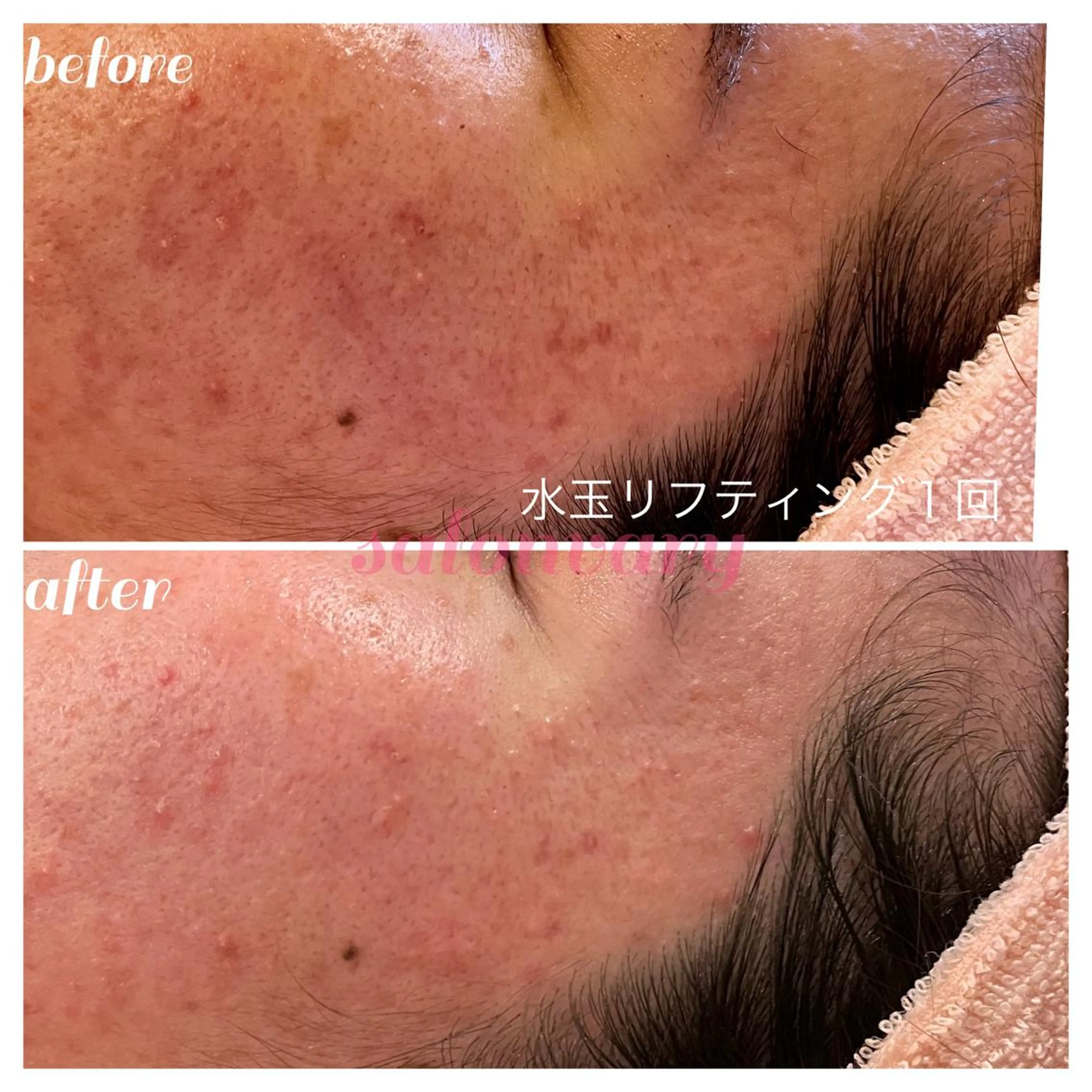 【ニキビ/肌管理】 salon varyのエステ・リラクイメージ