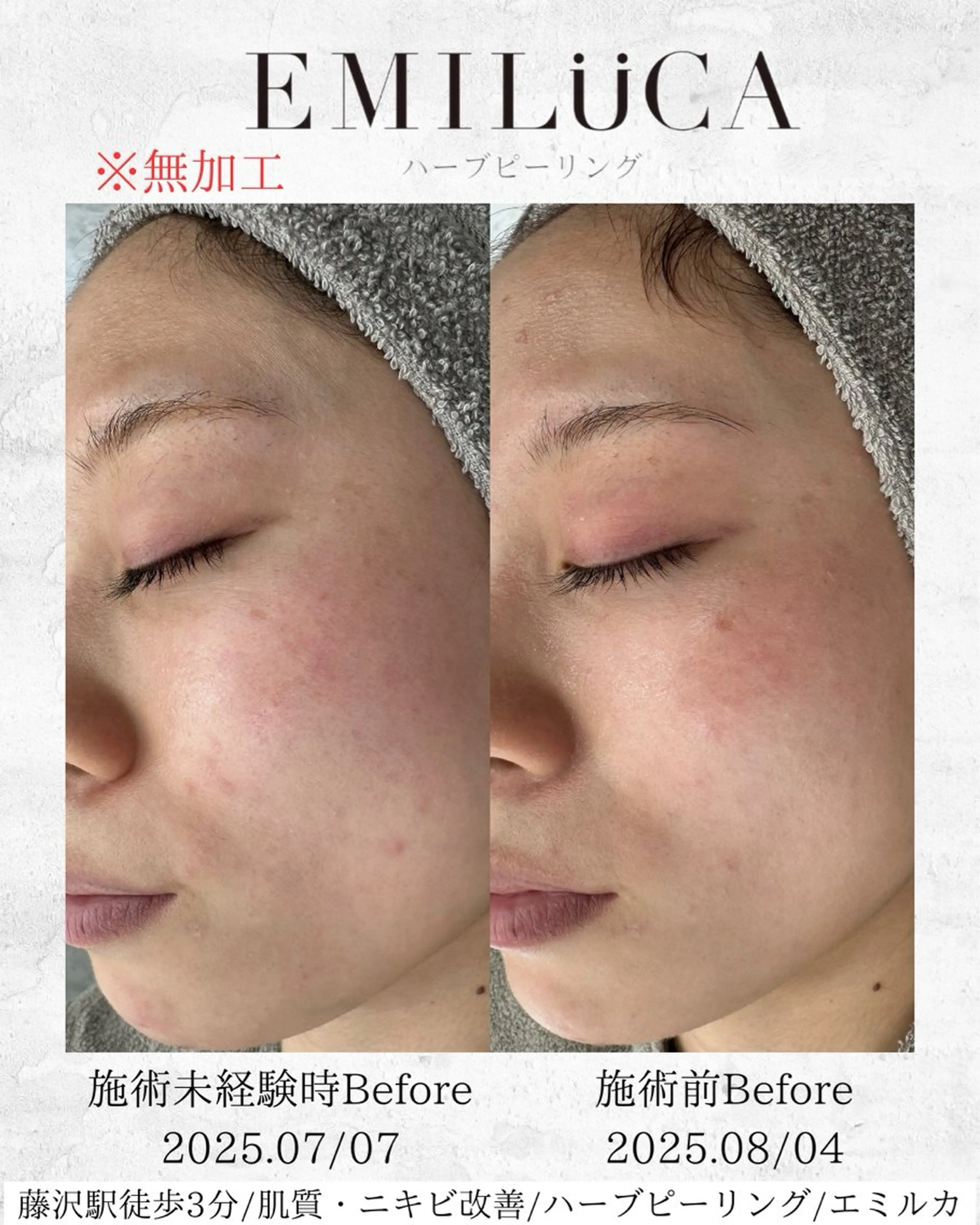 エステ ハーブピーリング /KAEDEのエステ・リラクイメージ