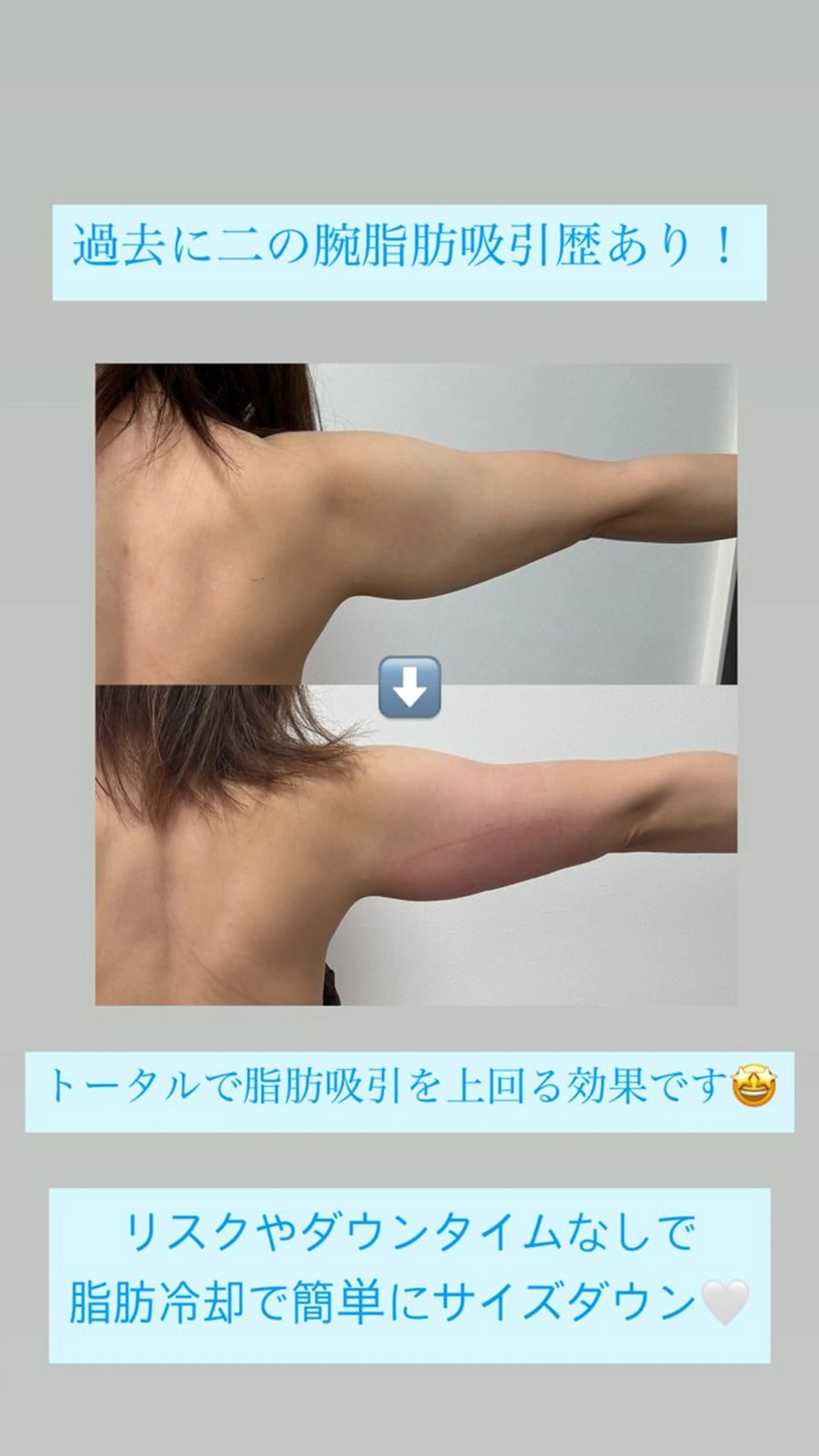 冷却痩身2カップ🧊ふくらはぎ、二の腕におすすめ◎の写真