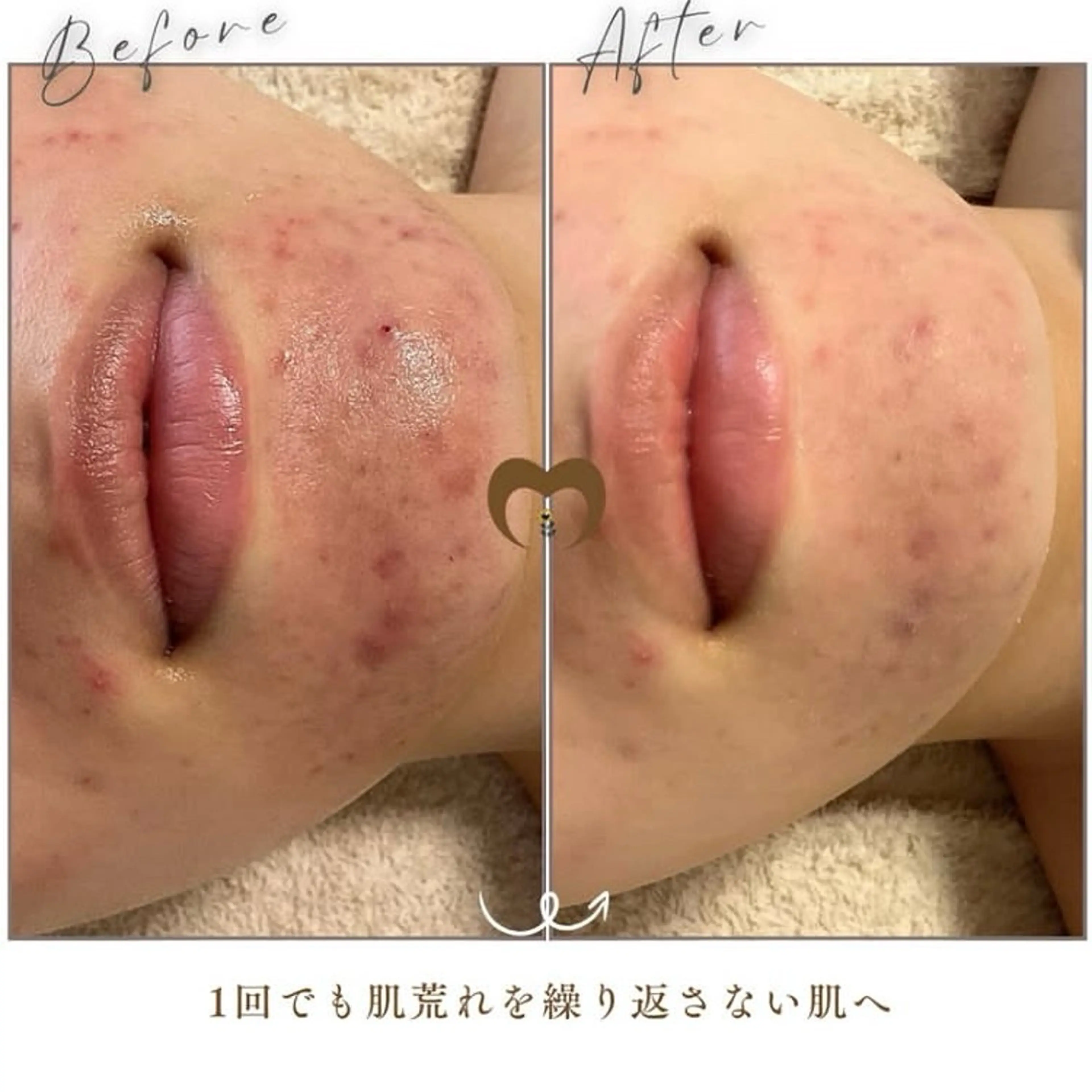 エステ リラク 繰り返すニキビ・毛穴 ✨つくば肌質改善専門のエステ・リラクイメージ