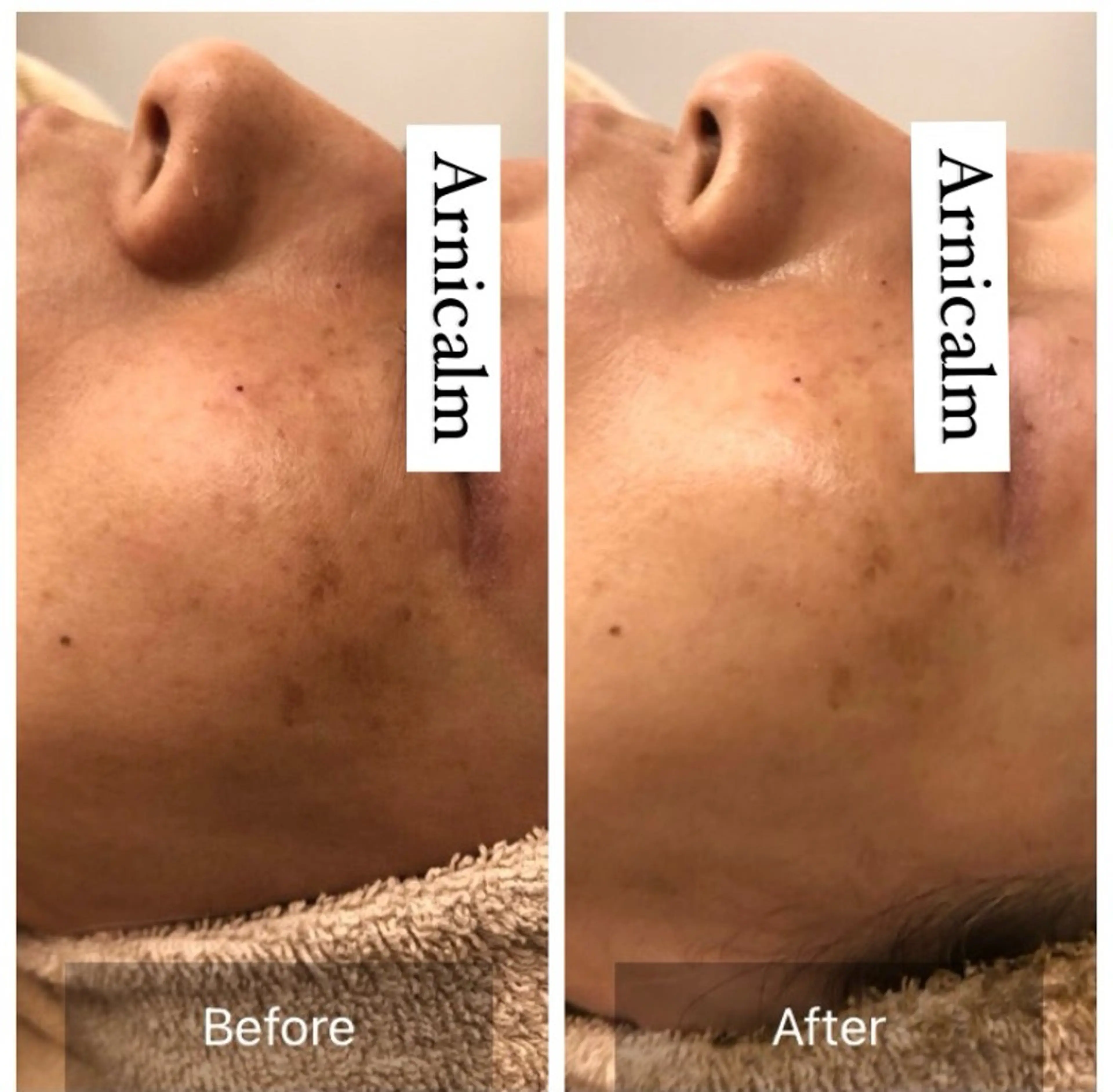 ハーブピーリング 肌再生ピーリング/のエステ・リラクイメージ