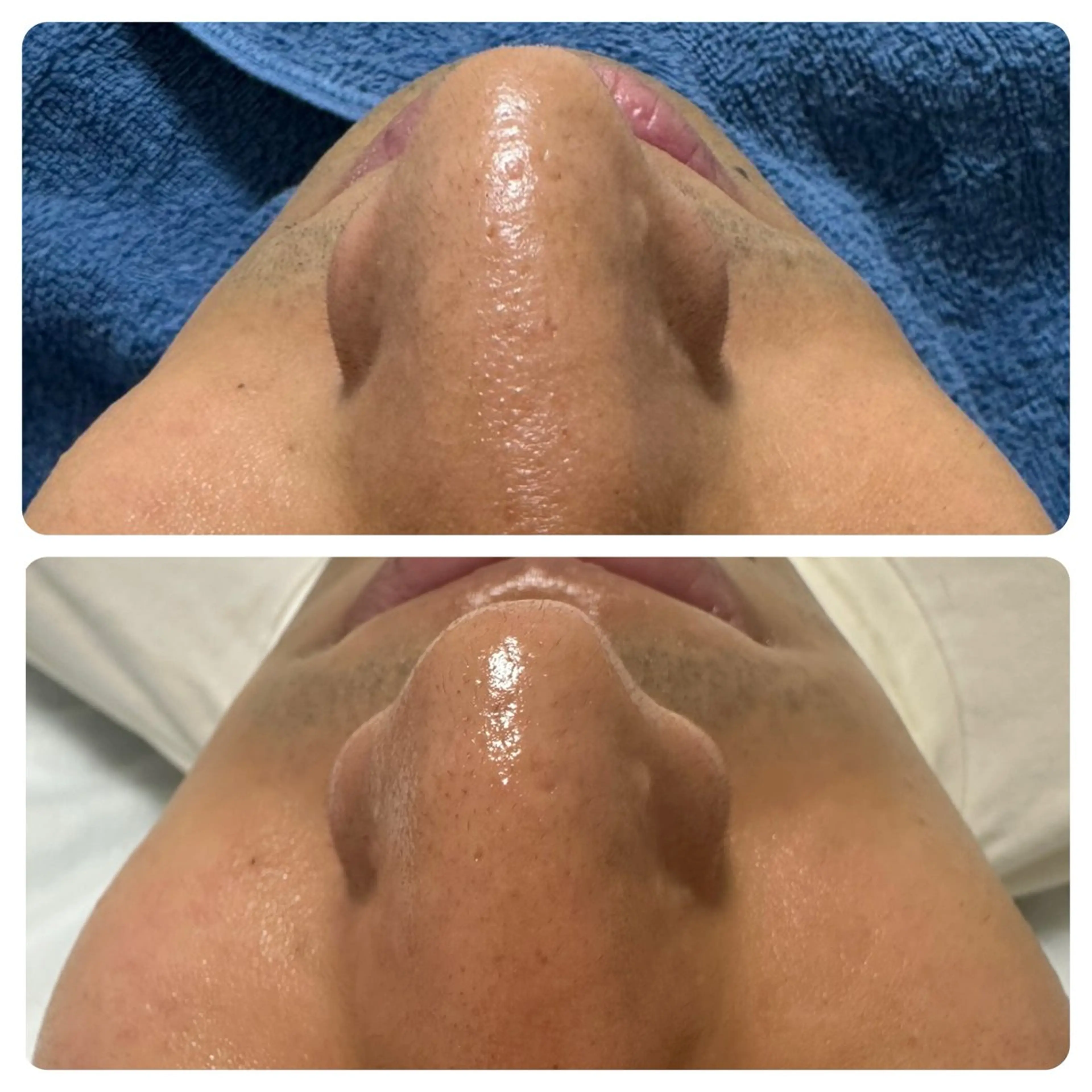 エステ 【赤ニキビ改善】 BELL'ET新宿店のエステ・リラクイメージ