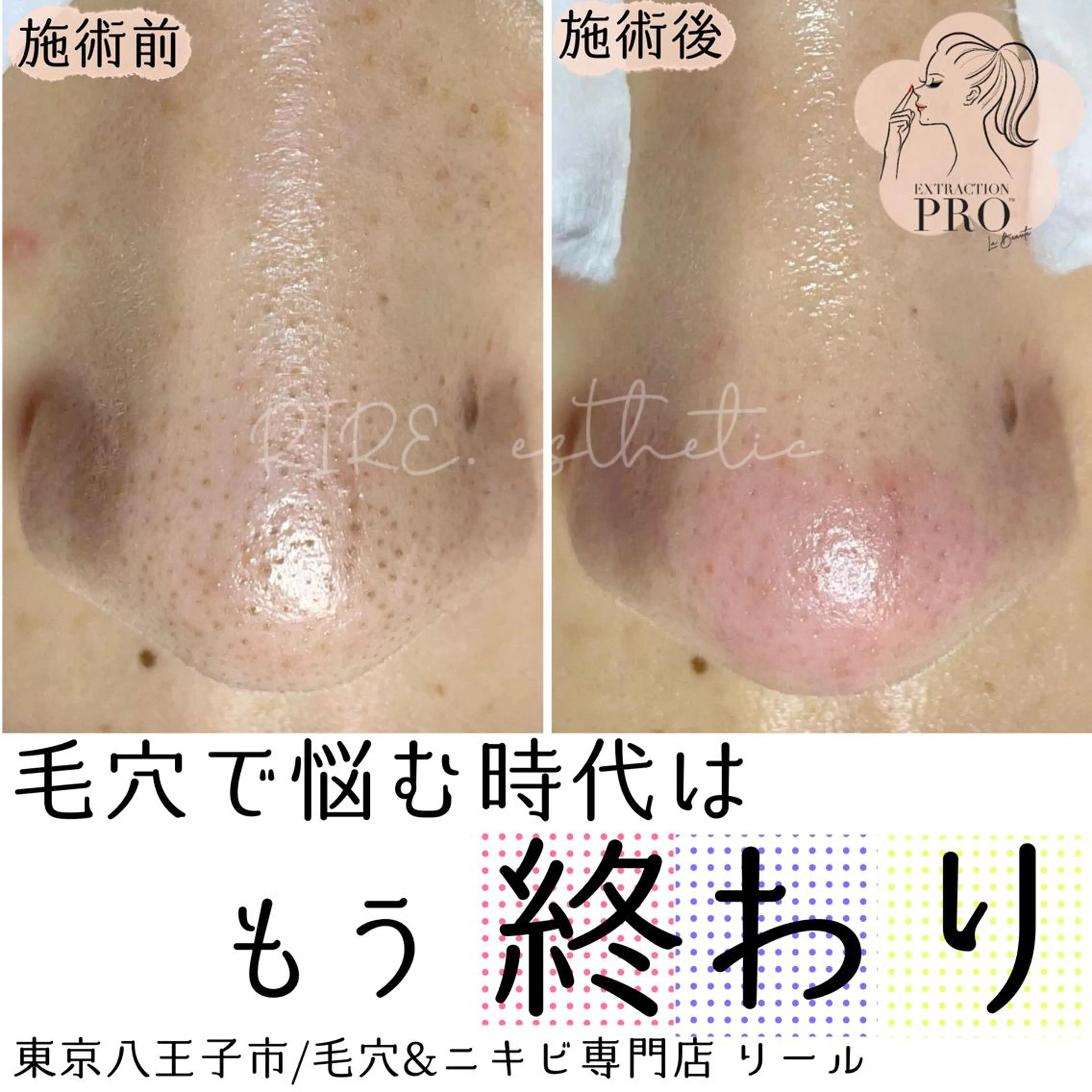 毛穴特化エステ -リールのエステ・リラクイメージ