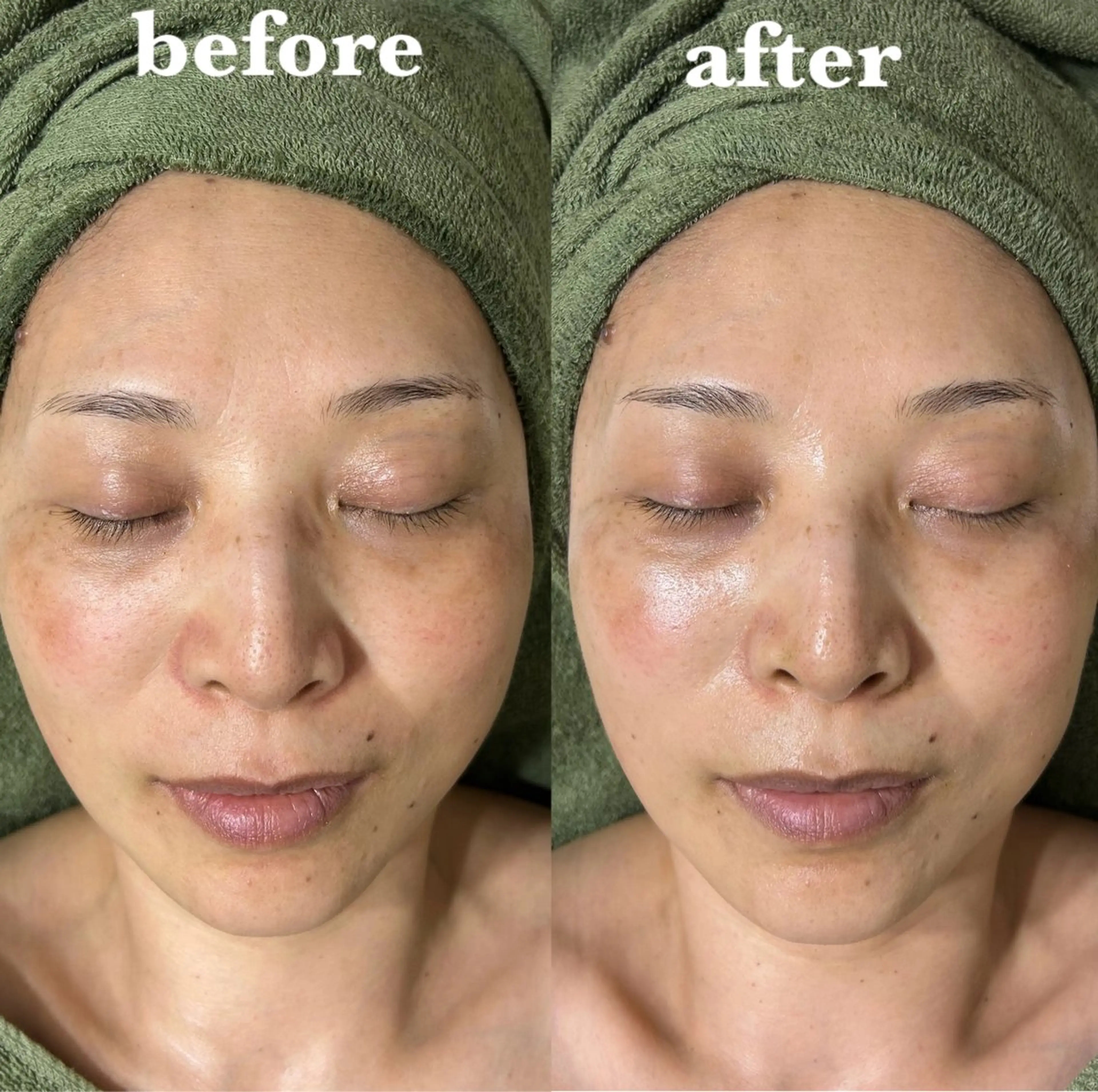 肌質改善＆脱毛 【M Mondo】のエステ・リラクイメージ