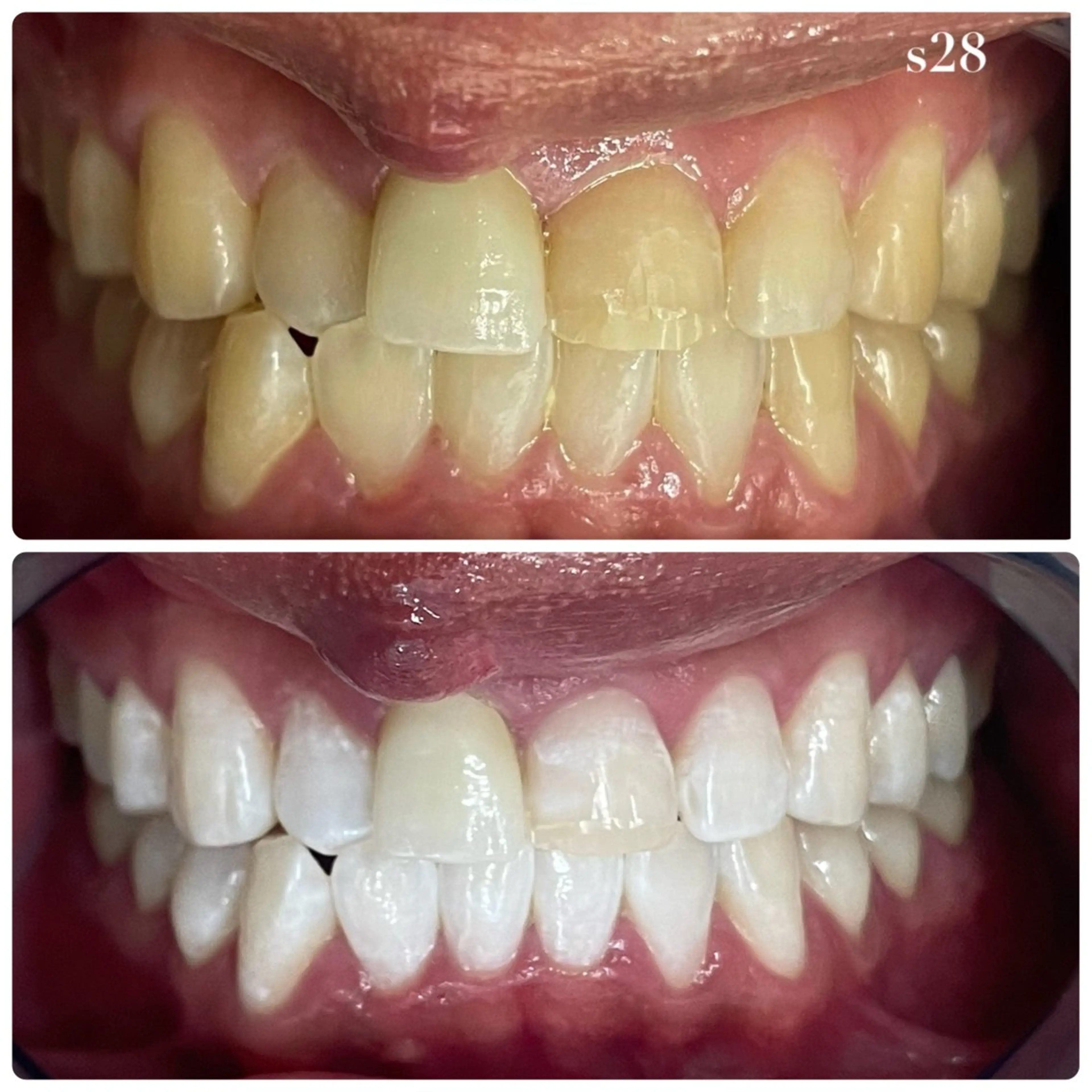 ✨一番人気✨【🔥圧倒的効果🔥】通常の倍照射!セルフホワイトニング8,800円🦷✨の写真