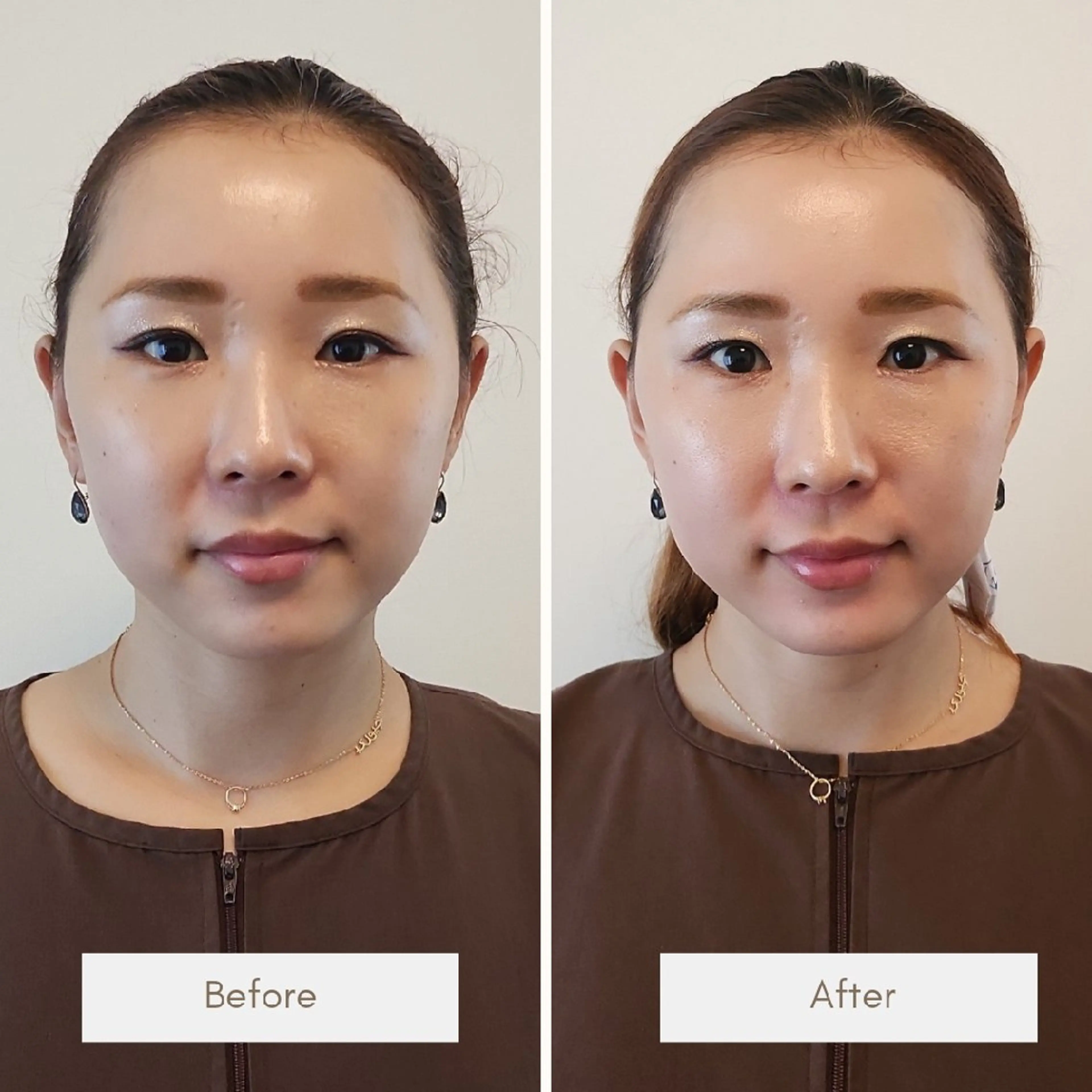 エステ リラク 即効⚡小顔美容鍼🪡 むくみたるみ脂肪解消のエステ・リラクイメージ