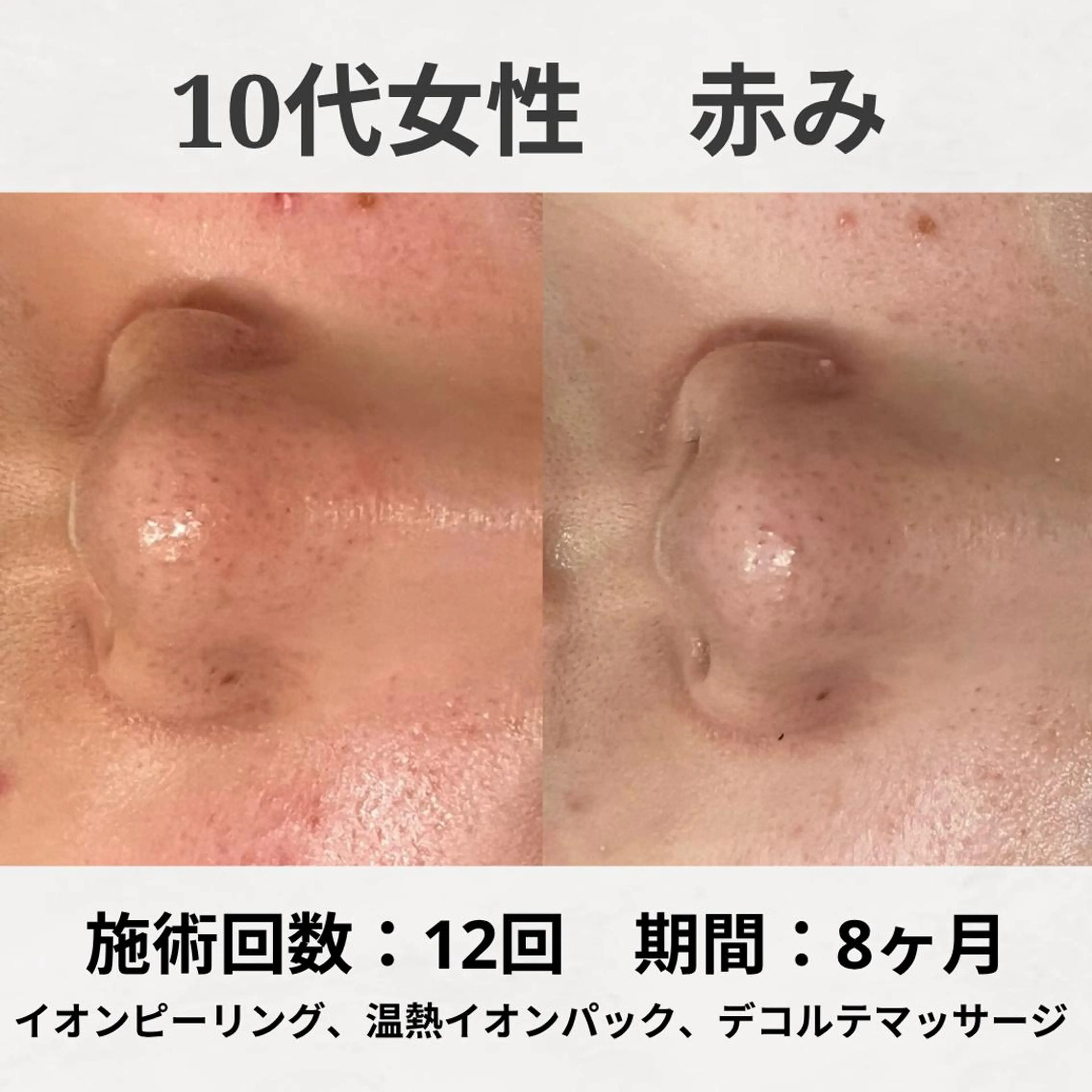 エステ リラク ニキビ跡改善専門🔥 医療にはできない改善のエステ・リラクイメージ