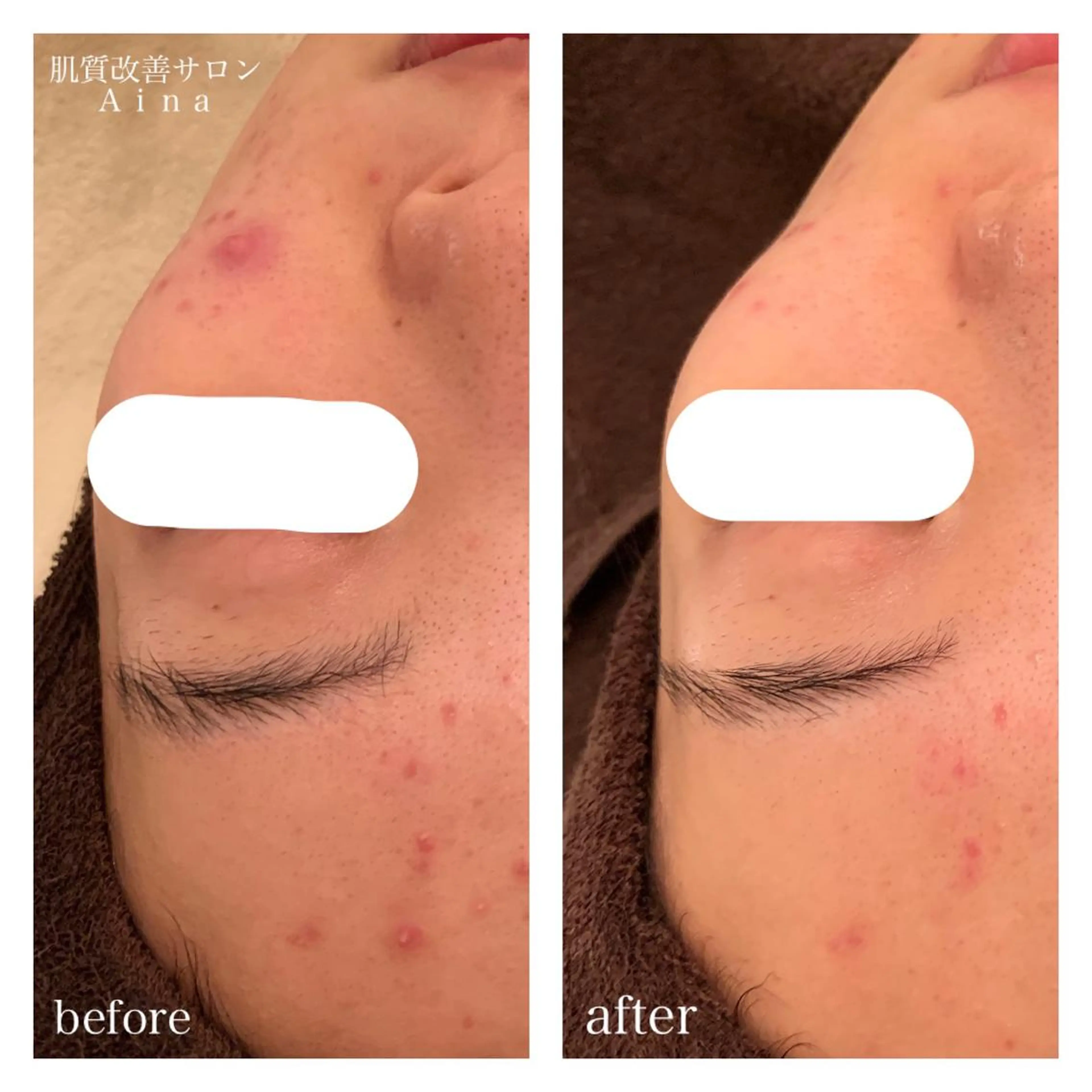 ショート カラー パーマ ヘアアレンジ メンズ キッズ ネイル マツエク・マツパ 赤色 ニキビ跡専門サロン Ａｉｎａのエステ・リラクイメージ