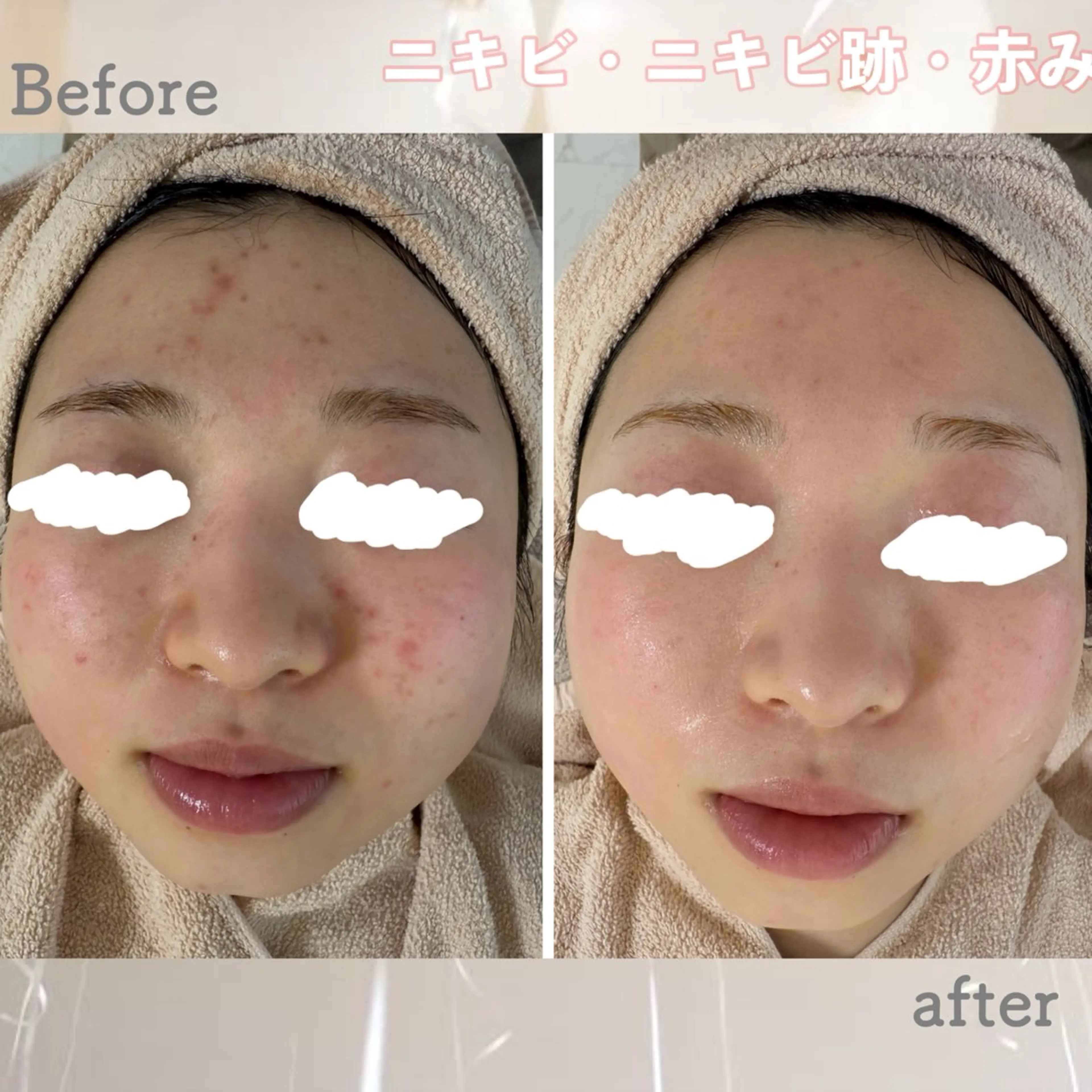 エステ ニキビ&跡改善サロン オーナー光木のエステ・リラクイメージ