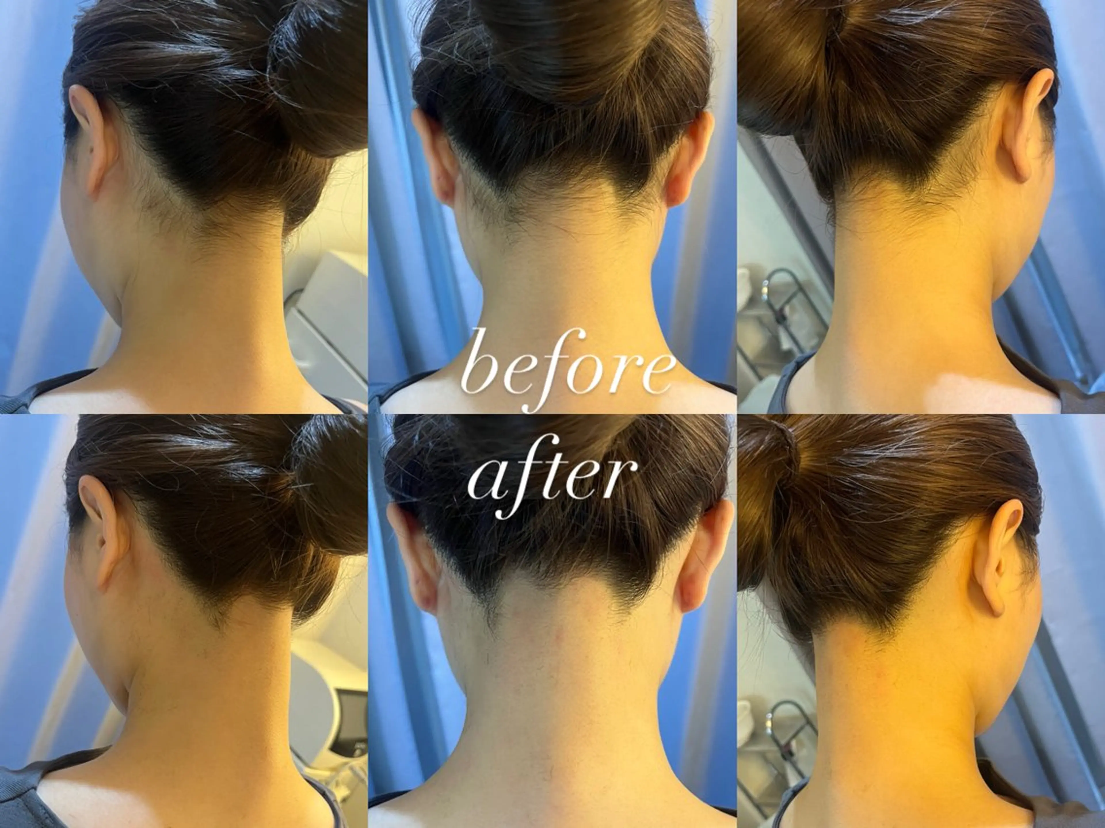 脱毛 うなじ脱毛/美肌脱毛 LABELのエステ・リラクイメージ