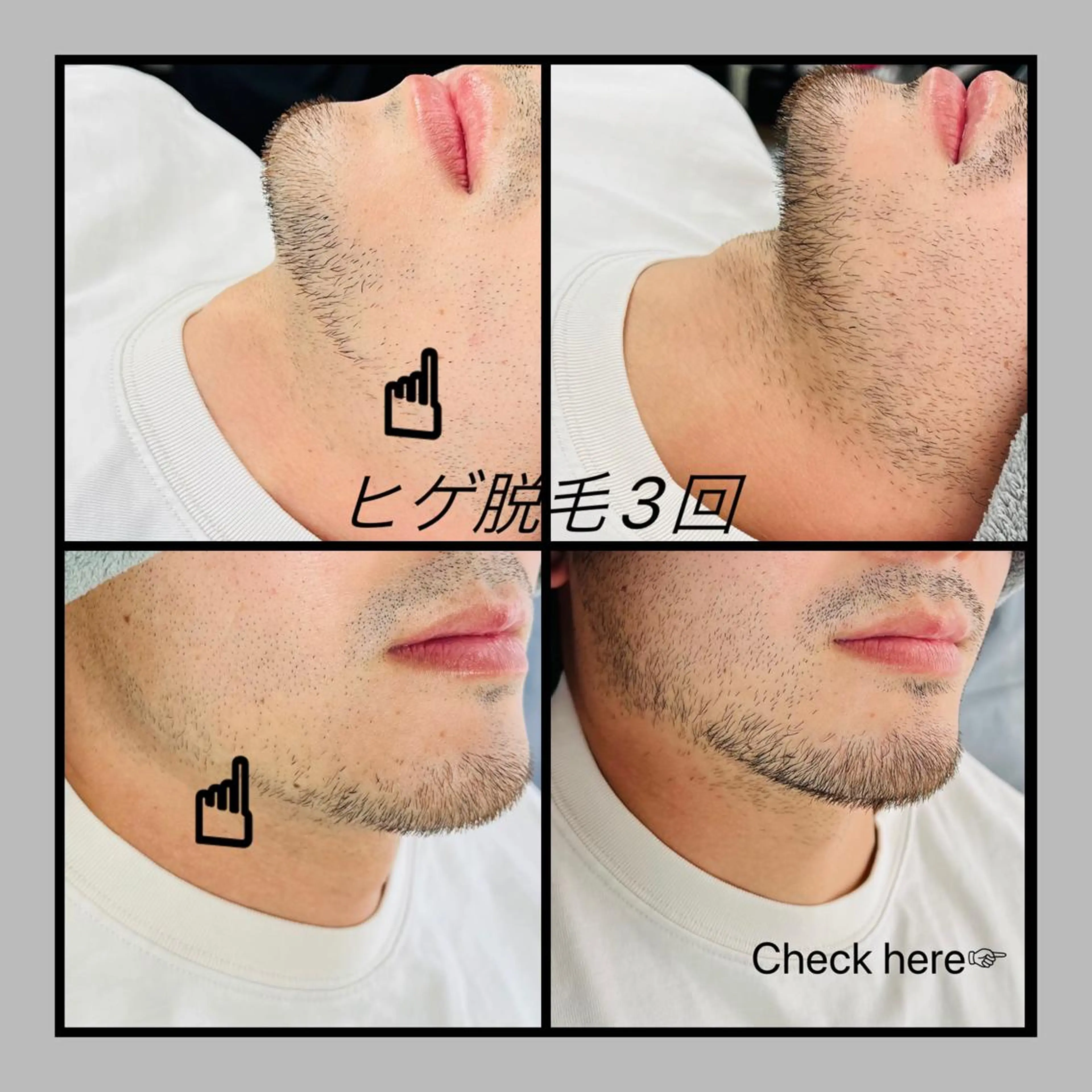 🚹限定❗️脱毛士による丁寧なヒゲ脱毛🥼他店で抜けなかった方、初めてで分からない方、丁寧なカウンセリング込みです🤓の写真