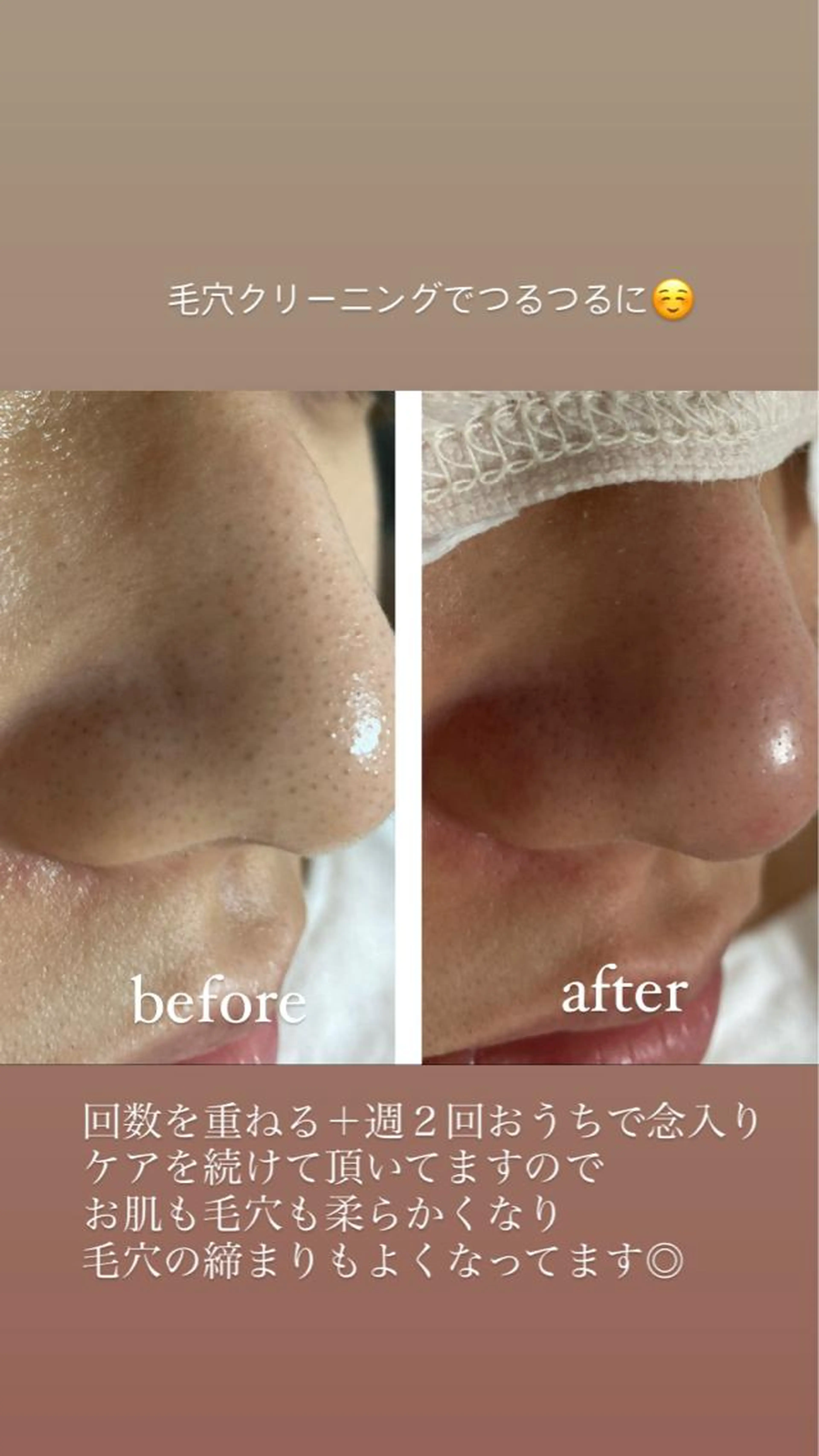 毛穴改善スタンダードコースの写真