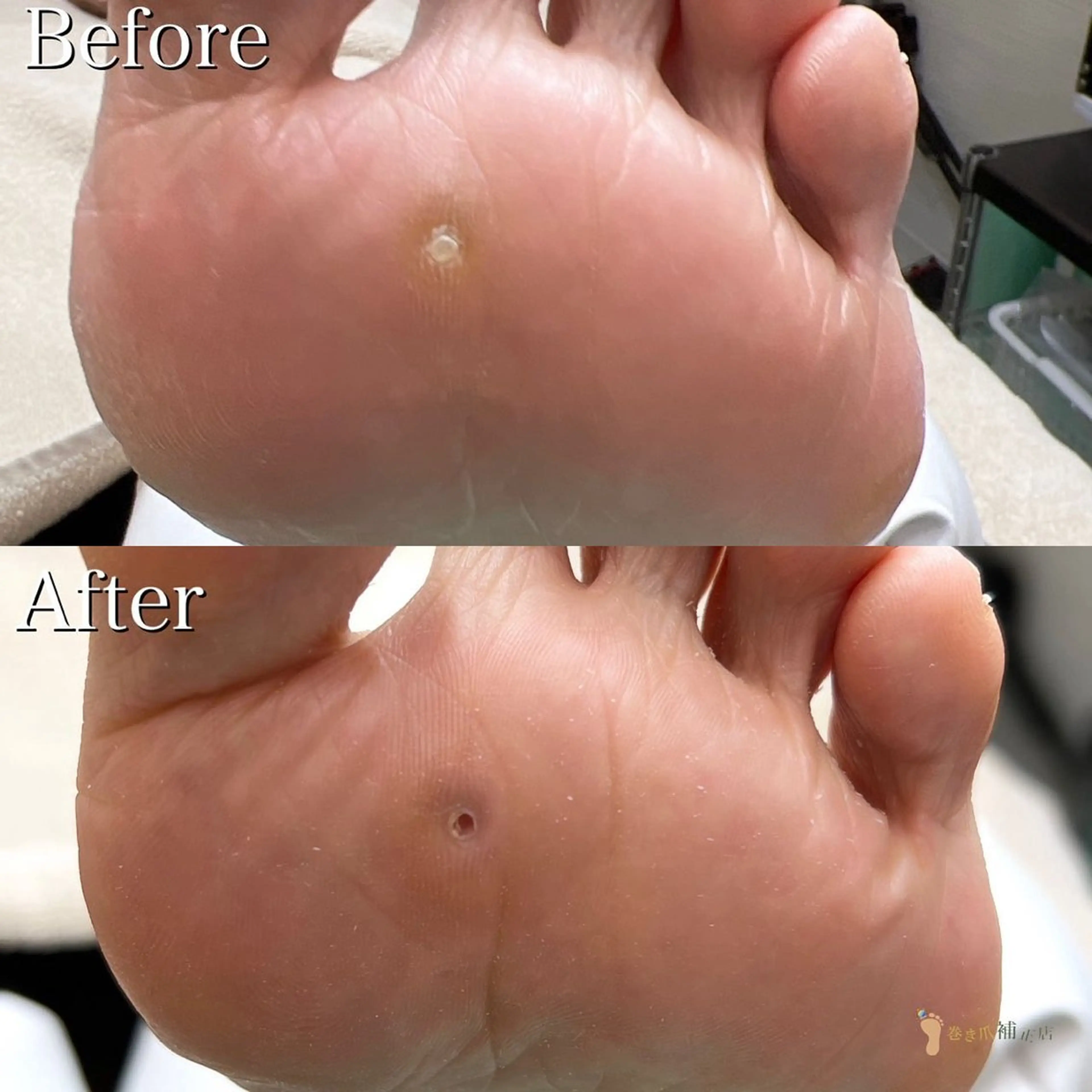 【トータル足裏ケア】足裏ゴワゴワ角質や痛​〜​い魚の目、かかとのガサガサをキレイに取り除きスベスベの足裏へ💁‍♀️の写真