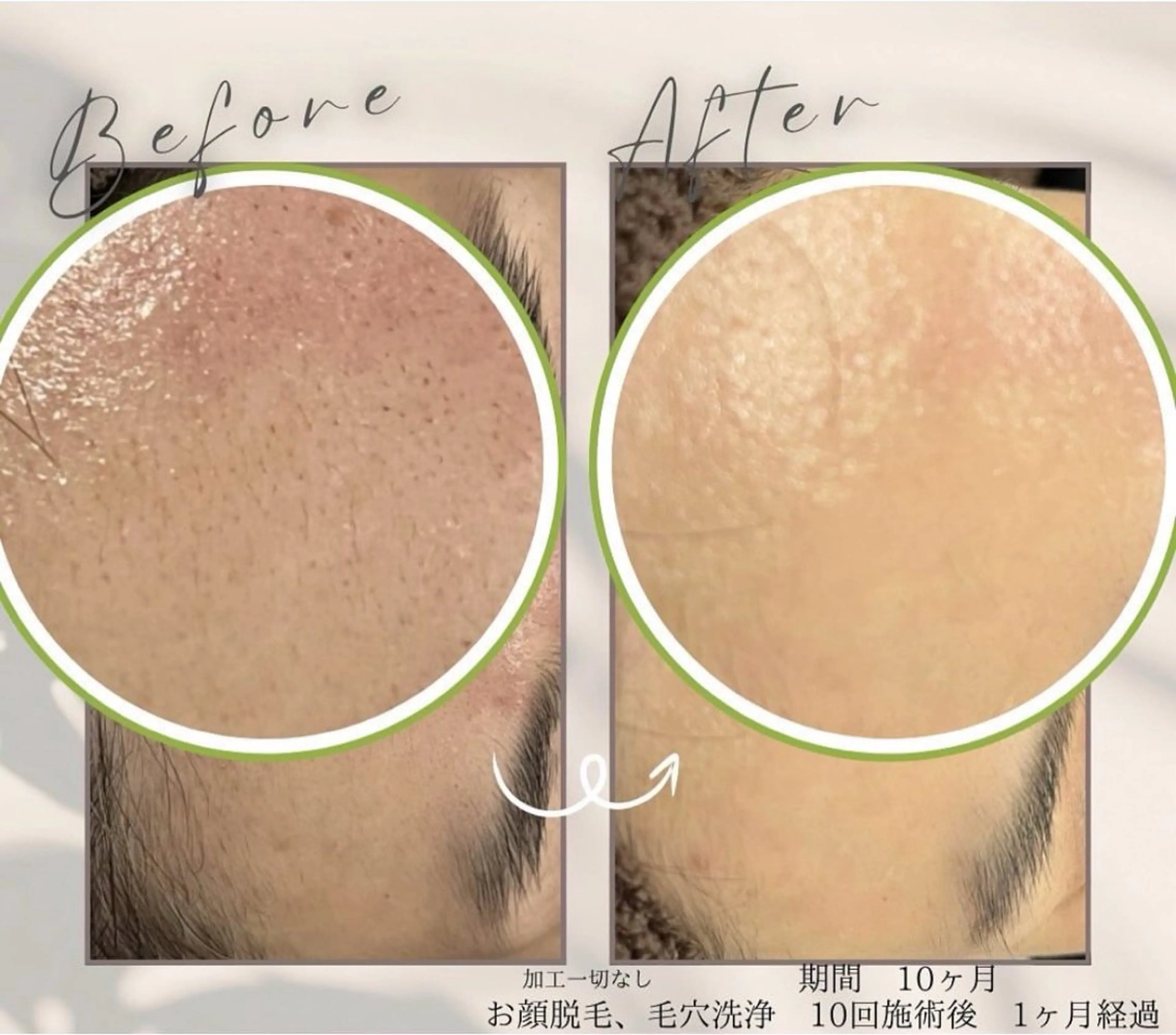 全身脱毛/顔を含む全身/ご自身で剃毛し来店の場合は1割引/ミニモ限定メニュープラズマありの写真