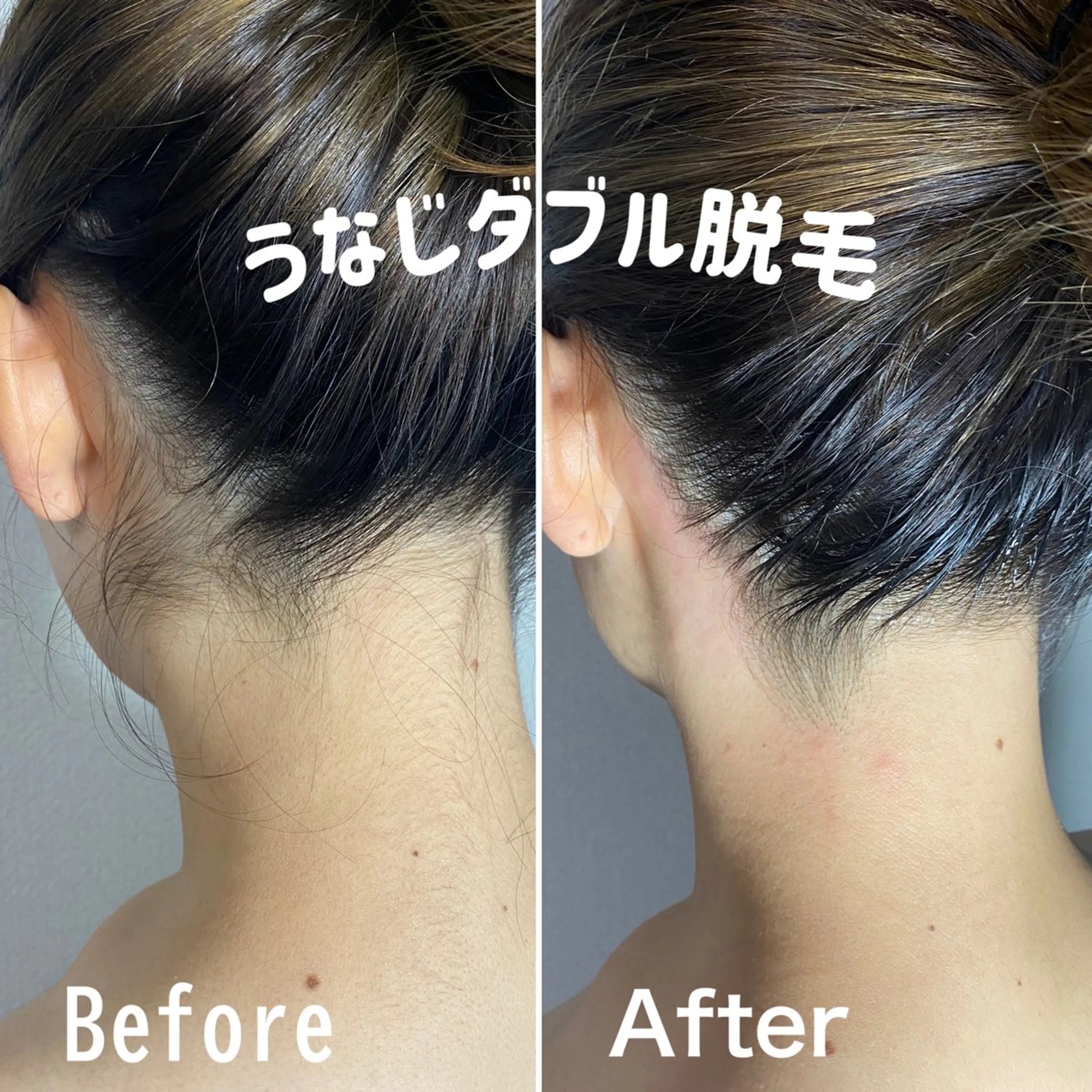 🌹ミニモ予約率No.1🌹うなじダブル脱毛(WAX＋高速光脱毛)【目指せうなじ美人✨🤍】◎口コミ必須の写真