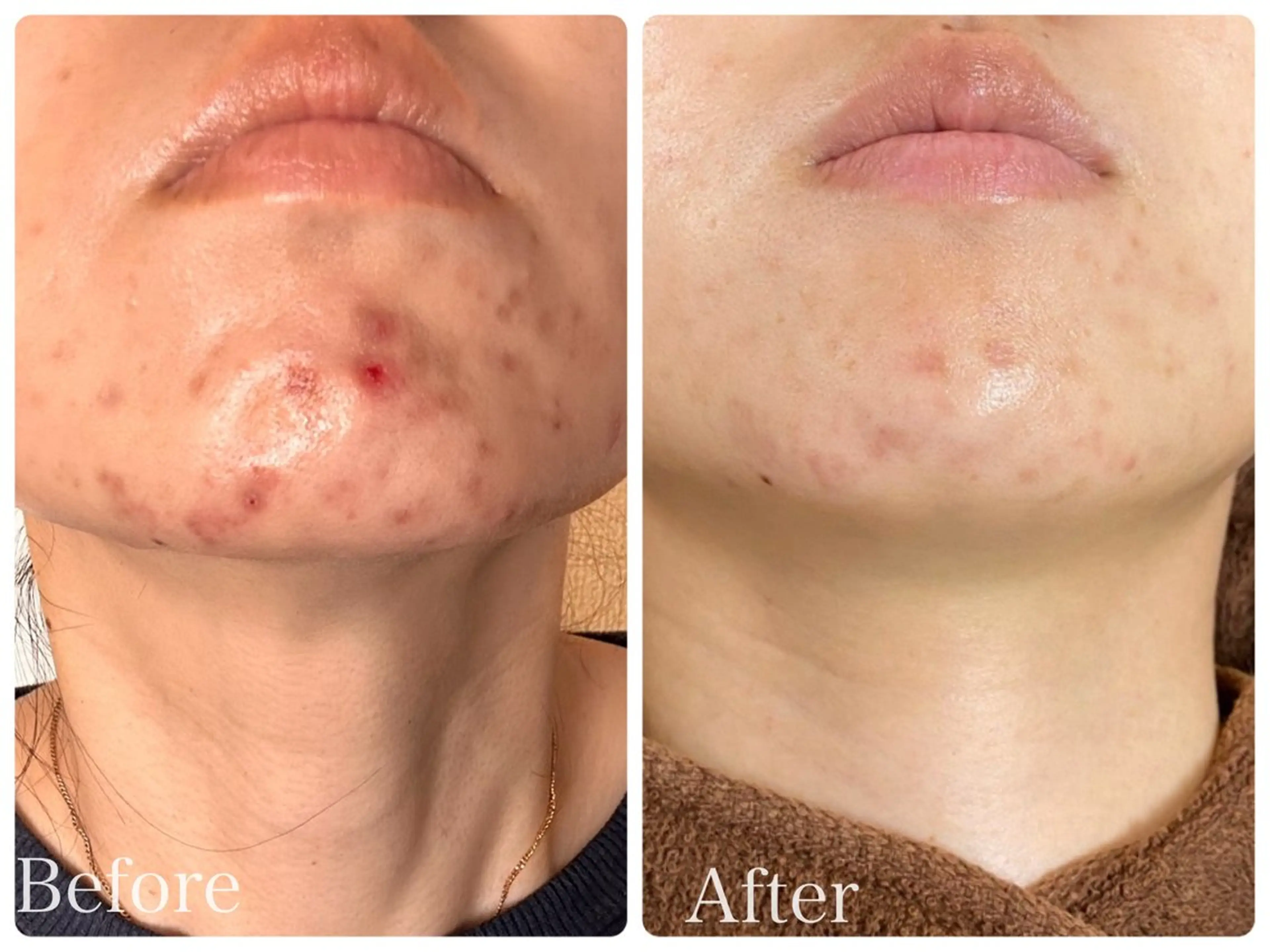 エステ リラク ニキビ・ 肌荒れ専門店のエステ・リラクイメージ