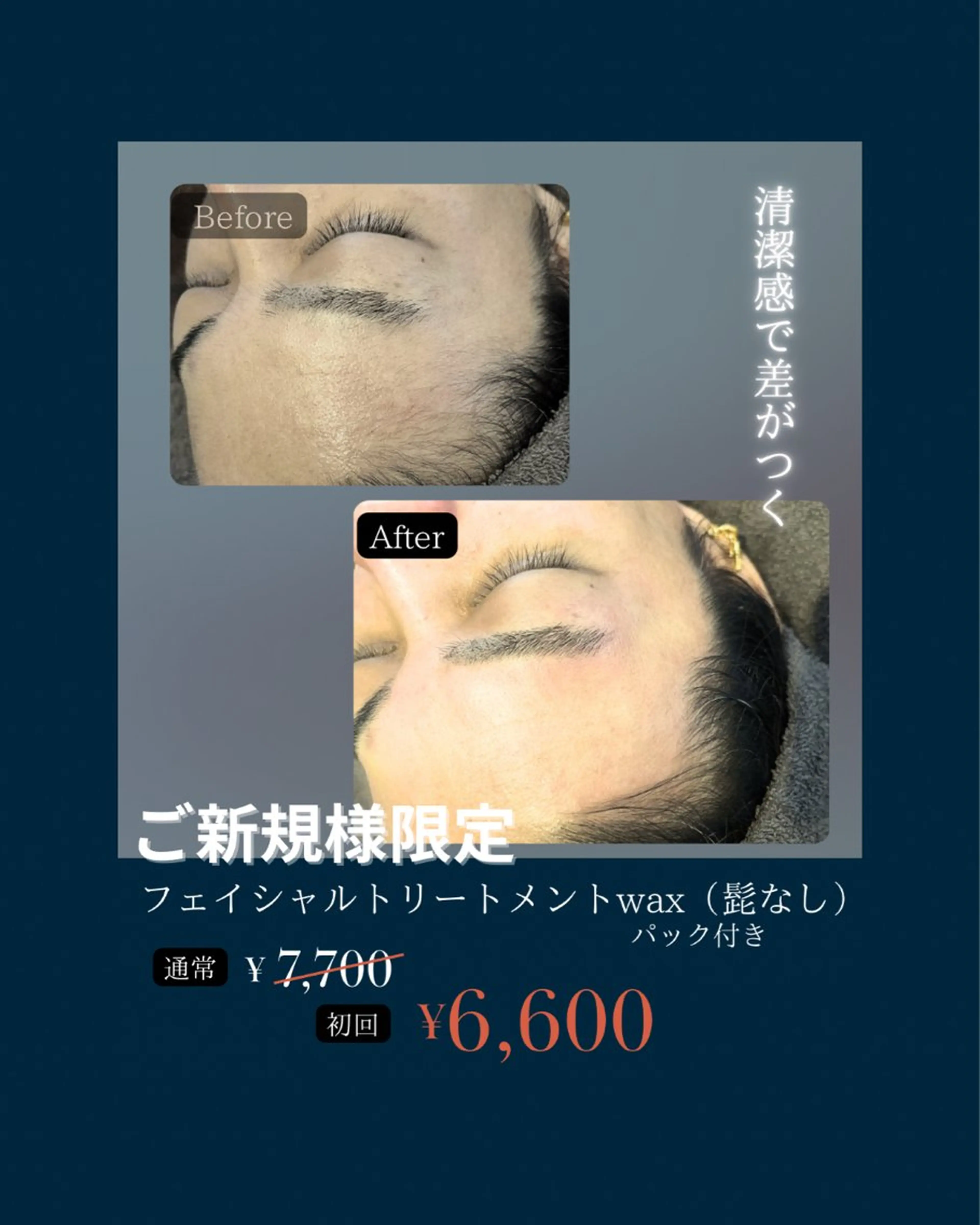 🟦メンズ限定🟦フェイシャルトリートメントwax脱毛（髭なし）の写真