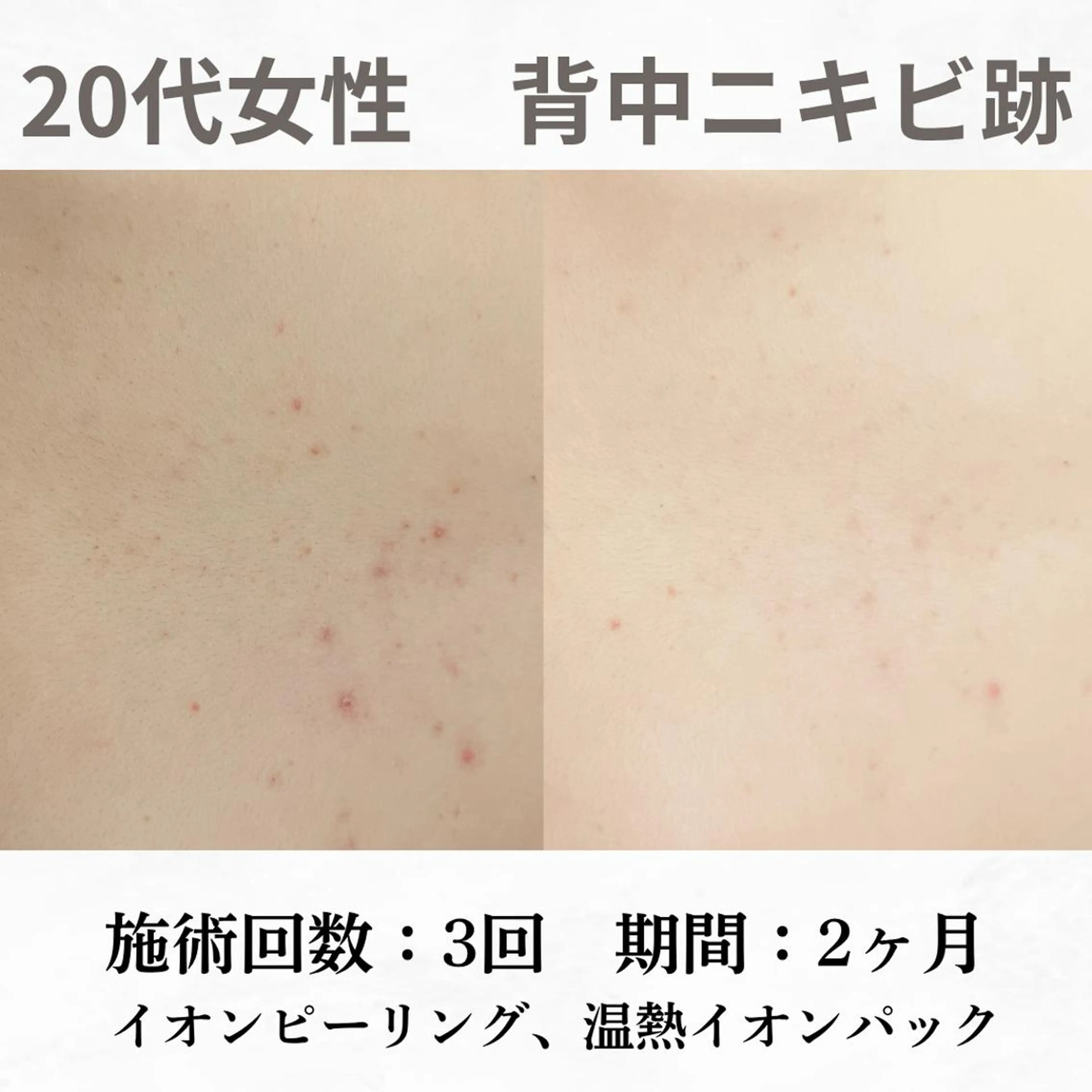 重度ニキビ専門🌷 ダウンタイムなしのエステ・リラクイメージ